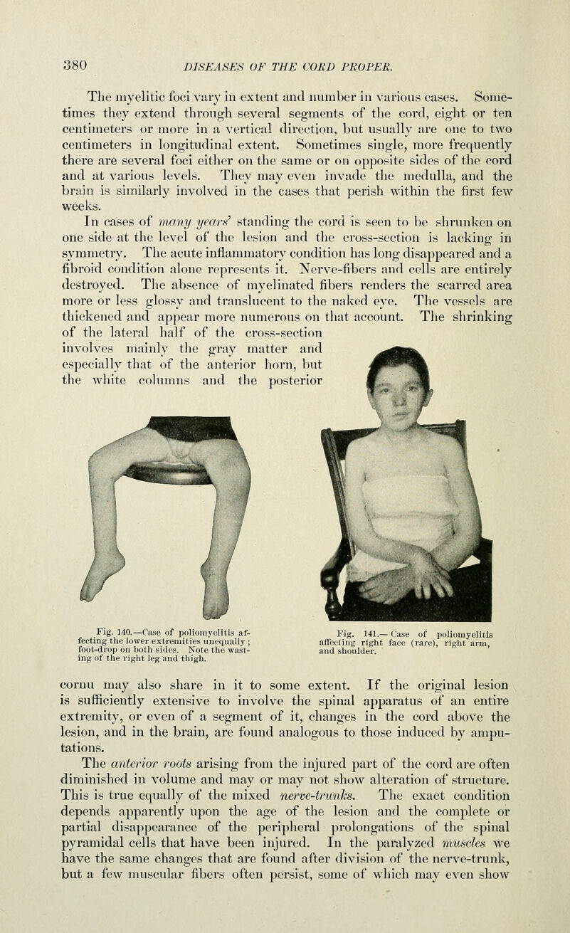 The myelitic foci vary in extent and number in various cases. Some- times they extend through several segments of the cord, eight or ten centimeters or more in a vertical direction, but usually are one to two centimeters in longitudinal extent. Sometimes single, more frequently there are several foci either on the same or on opposite sides of the cord and at various levels. They may even invade the medulla, and the brain is similarly involved in the cases that perish within the first few weeks. In cases of many years' standing the cord is seen to be shrunken on one side at the level of the lesion and the cross-section is lacking in symmetry. The acute inflammatory condition has long disappeared and a fibroid condition alone represents it. Nerve-fibers and cells are entirely destroyed. The absence of myelinated fibers renders the scarred area more or less glossy and translucent to the naked eye. The vessels are thickened and appear more numerous on that account. The shrinking of the lateral half of the cross-section involves mainly the gray matter and especially that of the anterior horn, but the white columns and the posterior Fig. 140.—Case of poliomyelitis af- fecting the lower extremities unequally ; foot^drop on both sides. Note the wast- ing of the right leg and thigh. Fig. 141.— Case of poliomyelitis affecting right face (rare), right arm, and shoulder. cornu may also share in it to some extent. If the original lesion is sufficiently extensive to involve the spinal apparatus of an entire extremity, or even of a segment of it, changes in the cord above the lesion, and in the brain, are found analogous to those induced by ampu- tations. The anterior roots arising from the injured part of the cord are often diminished in volume and may or may not show alteration of structure. This is true equally of the mixed nerve-trunks. The exact condition depends apparently upon the age of the lesion and the complete or partial disappearance of the peripheral prolongations of the spinal pyramidal cells that have been injured. In the paralyzed muscles we have the same changes that are found after division of the nerve-trunk, but a few muscular fibers often persist, some of which may even show