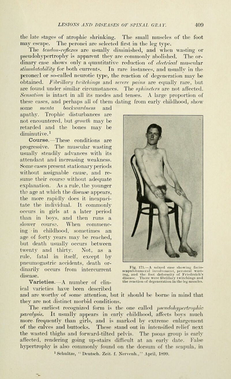 the late stages of atrophic shrinking. The small muscles of the foot may escape. The peronei are selected first in the leg type. The tendon-reflexes are usually diminished, and when wasting or pseudohypertrophy is aj^parent they are commonly abolished. The or- dinary case shows only a quantitative reduction of electrical muscular stimulatability for both currents. In rare instances, and usuallv in the peroneal or so-called neurotic type, the reaction of degeneration may be obtained. Fihrillari/ ticitchings and severe pains are equally rare, but are found under similar circumstances. The sphincters are not affected. Sensation is intact in all its modes and tenses. A large proportion of these cases, and perhaps all of them dating from early childhood, show some menta backwardness and apathy. Trophic disturbances are not encountered, but growth may be retarded and the bones may be diminutive.-^ Course.—These conditions are progressive. The muscular wasting usually steadily advances with its attendant and increasing weakness. Some cases present stationary periods without assignable cause, and re- sume their cours9 without adequate explanation. As a rule, the younger the age at which the disease appears, the more rapidly does it incapaci- tate the individual. It commonly occurs in girls at a later period than in boys, and then runs a slower course. When commenc- ing -in childhood, sometimes an age of forty years may be reached, but death usually occurs between twenty and thirty. Not, as a rule, fatal in itself, except by pneumogastric accidents, death or- dinarily occurs from intercurrent disease. Varieties.—A number of clin- ical varieties have been described and are wortliy of some attention, but it should be borne in mind that they are not distinct morbid conditions. The earliest recognized form is the one called jmmdohypertrophic paralysis. It usually a]jpears in early chiklhood, affects boys nmch more- frequently than girls, and is marked by extreme enlargement of the calves and buttocks. These stand out in intensified relief next the wasted thighs and forward-tilted peh'is. The psoas gi'oup is early affected, rendering going up-stairs difficult at an early date. False hypertrophy is also commonly found on the dorsum of the scapula, in iSchultze, '-Deutsch. Zeit. f. Nervenh., April, 1899. Fig. 175.—A mixed case .showing fucio- scapuloliumeiiil involveiiieiil, peroiieiil wast- ing, and llie foot del'oriuity of Fiiedieicli's disease. Tliere were fibrillary twitcliings and the reaction of degeneration in the leg muscles.