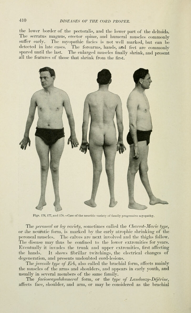 the lower border of the pectoralis, and the lower part of the deltoids. The serratus magnus, erector spinse, and humeral muscles commonly suifer early. The myopathic facies is not well marked, but can be detected in late cases. The forearms, hands, and feet are commonly spared until the last. The enlarged muscles finally shrink, and present all the features of those that shrink from the first. Figs. 176,177, and 178.—Case of the neuritic varietv of family progressive myopathy. The peroneal or ler/ variety, sometimes called the Charcot-JIarie type, or the neurotic form, is marked by the early atrophic shrinking of the peroneal muscles. The calves are next involved and the thighs follow% The disease may thus be confined to the lower extremities for years. Eventually it invades the trunk and upper extremities, first affecting the hands. It shows fibrillar twitchings, the electrical changes of degeneration, and presents undoubted cord-lesions. The juvenile type of Erh, also called the brachial form, affects mainly the muscles of the arms and shoulders, and appears in early youth, and usually in several members of the same family. The facioscapulohumeral form, or the type of Landouzy-Dejerine, affects face, shoulder, and arm, or may be considered as the brachial