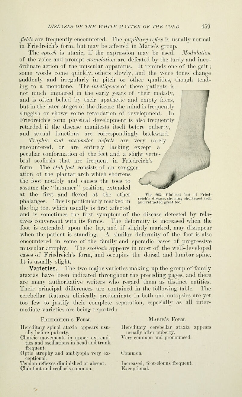 fields are frequently encountered. The pupillai'y reflex is usually normal in Friedreich's form, but may be affected in Marie's group. The speech is ataxic, if the expression may be used. Modulation of the voice and prompt enunciation are defeated by the tardy and inco- ordinate action of the muscular apparatus. It reminds one of the gait; some words come quickly, others slowly, and the voice tones change suddenly and irregularly in pitch or other qualities, though tend- ing to a monotone. The intelligence of these patients is not much impaired in the early years of their malady, and is often belied by their apathetic and empty faces, but in the later stages of the disease the mind is frequently sluggish or shows some retardation of development. In Friedreich's form physical development is also frequently retarded if the disease manifests itself before puberty, and sexual functions are correspondingly backward. Trophic and vasomotor defects are very rarely encountered, or are entirely lacking except a peculiar conformation of the feet and a slight verte- bral scoliosis that are frequent in Friedreich's form. The cliih-foot consists of an exagger- j -^ ation of the plantar arch which shortens the foot notably and causes the toes to assume the hammer position, extended at the first and flexed at the other Fig. 2o.s.—ciuhbed foot of Fried- , , rni • • 1 • 1 1 11- reich's disease, sliowiiig sliortened arch phalanges, i his is particularly marked m and retracted great toe. the big toe, which usually is first affected and is sometimes the first symptom of the disease detected by rela- tives conversant with its forms. The deformity is increased when the foot is extended upon the leg, and if slightly marked, may disappear when the patient is standing. A similar deformity of the foot is also encountered in some of the family and sporadic cases of progressive muscular atrophy. The scoliosis appears in most of the well-developed cases of Friedreich's form, and occupies the dorsal and lumbar spine. It is usually slight. Varieties.—The two major varieties making up the group of family ataxias have been indicated throughout the preceding pages, and there are many authoritative writers who regard them as distinct entities. Their principal differences are contained in the following table. The cerebellar features clinically predominate in both and autopsies are yet too few to justify their complete separation, especially as all inter- mediate varieties are being reported : Friedreich's Form. Marie's Form. Hereditary spinal ataxia ai^pears u.su- Hereditary cerebellar ataxia appears ally before puberty. usually after inibevty. Choreic movements in upper cxtremi- Very common and pronounced. ties and oscillations in head and trunk frequent. Optic atrophy and amblyopia very ex- Common. cei)tional. Tendon reflexes diminished or absent. Increased, foot-clonus frequent. Club-foot and scoliosis common. Exceptional.