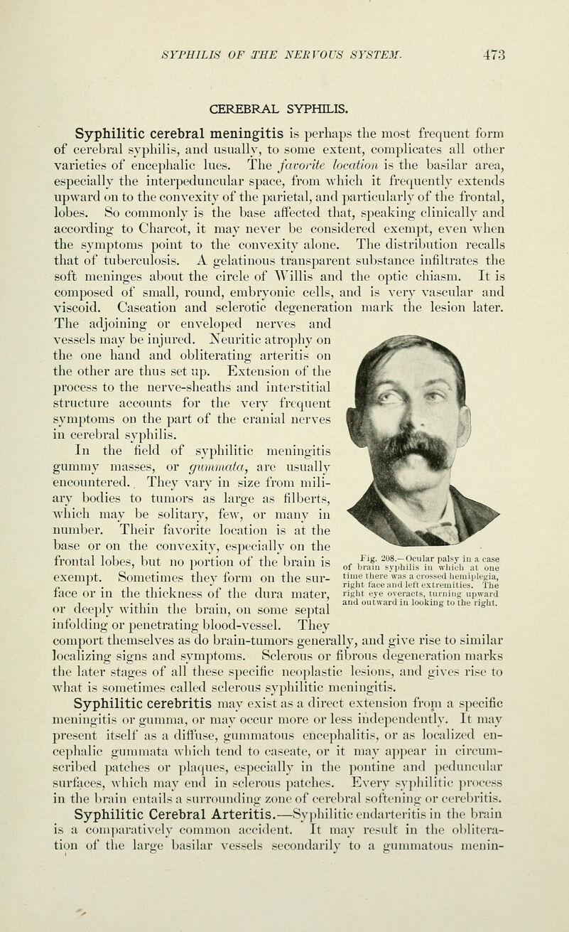 CEREBRAL SYPHILIS. Syphilitic cerebral meningitis is perhaps the most frequent form of cerebral syphilis, and usually, to some extent, complicates all other varieties of encephalic lues. The favorite location is the basilar area, especially the interpeduncular space, from which it frequently extends upward on to the convexity of the parietal, and particularly of the frontal, lobes. So commonly is the base affected that, speaking clinically and according to Charcot, it may never be considered exempt, even w^ien the symptoms point to the convexity alone. The distribution recalls that of tuberculosis. A gelatinous transparent substance infiltrates the soft meninges about the circle of Willis and the optic chiasm. It is composed of small, round, embryonic cells, and is very vascular and viscoid. Caseation and sclerotic degeneration mark the lesion later. The adjoining or enveloped nerves and vessels may be injured. Neuritic atrophy on the one hand and obliterating arteritis on the other are thus set up. Extension of the process to the nerve-sheaths and interstitial structure accounts for the very frequent symptoms on the part of the cranial nerves in cerebral syphilis. In the field of syphilitic meningitis gummy masses, or gummata, are usually encountered., They vary in size from mili- ary bodies to tumors as large as filberts, which may be solitary, few, or many in number. Their favorite location is at the base or on the convexity, especially on the frontal lobes, but no portion of the brain is exempt. Sometimes they form on the sur- face or in the thickness of the dura mater, or deeply within the brain, on some septal infolding or penetrating blood-vessel. They comport themselves as do brain-tumors generally, and give rise to similar localizing signs and symptoms. Sclerous or fibrous degeneration marks the later stages of all these specific neoplastic lesions, and gives rise to what is sometimes called sclerous syphilitic meningitis. Syphilitic cerebritis may exist as a direct extension from a specific meningitis or gunniia, or may occur more or less independently. It may present itself as a diffuse, gunmiatous encephalitis, or as localized en- cephalic gummata which tend to caseate, or it may appear in circum- scribed patches or plaques, especially in the pontine and peduncular surfaces, Avhich may end in sclerous patches. Every sypliilitic process in the brain entails a surrounding zone of cerebral softening or cerebritis. Syphilitic Cerebral Arteritis.—Syphilitic endarteritis in the brain is a coui])aratively common accident. It may result in the oblitera- tion of the large basilar vessels secondarily to a gummatous menin- Fig. 208.—Ocular palsy in a case of braiu syphilis iu which at one time there was a crossed hemiplegia, right face and left extremities. The right eye overacts, turning upward and outward iu looking to the right.