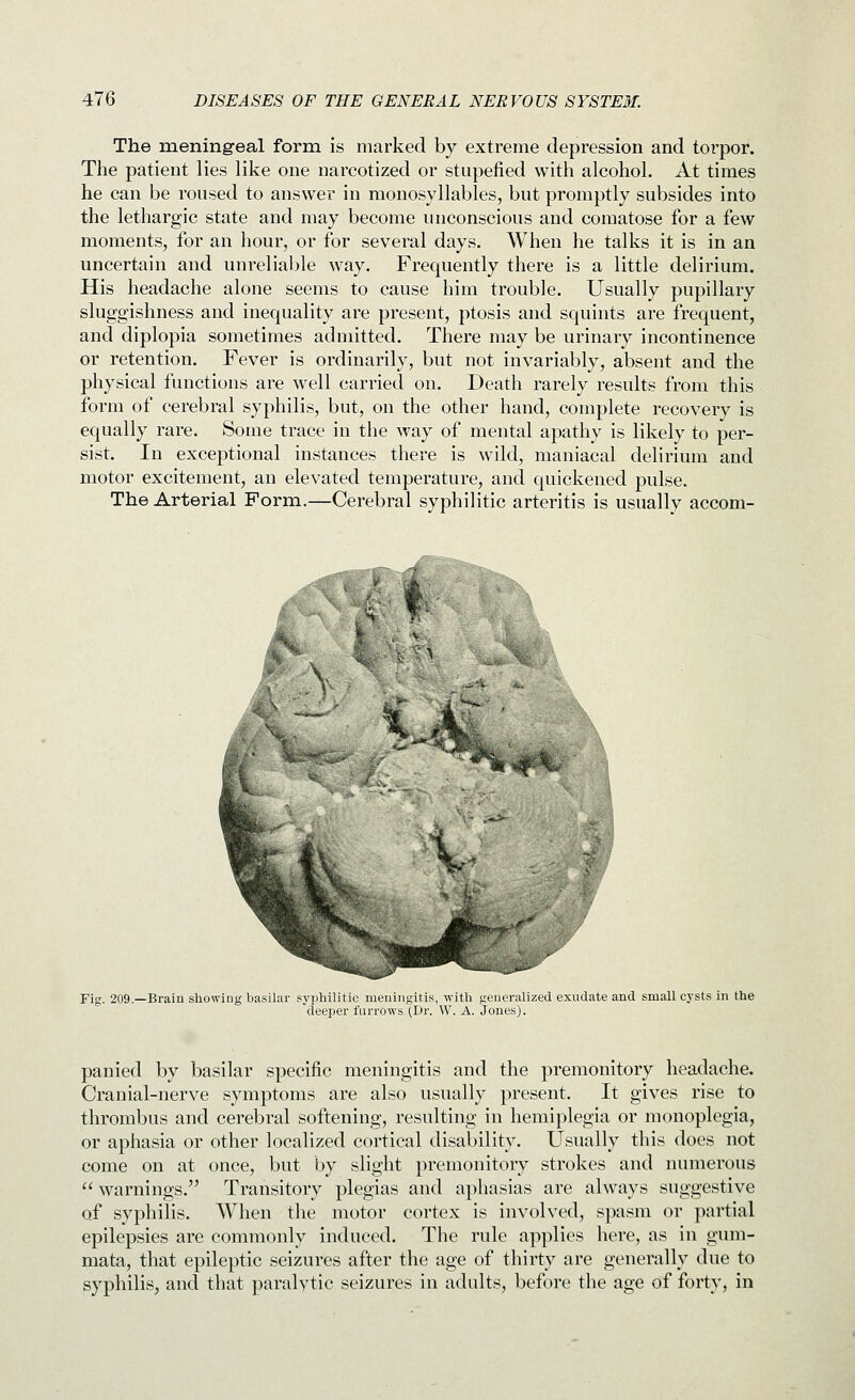 The meningeal form is marked by extreme depression and toi'por. The patient lies like one narcotized or stupefied with alcohol. At times he can be roused to answer in monosyllables, but promptly subsides into the lethargic state and may become unconscious and comatose for a few moments, for an hour, or for several days. When he talks it is in an uncertain and unreliable way. Frequently there is a little delirium. His headache alone seems to cause him trouble. Usually pupillary sluggishness and inequality are present, ptosis and squints are frequent, and diplopia sometimes admitted. There may be urinary incontinence or retention. Fever is ordinarily, but not invariably, absent and the physical functions are well carried on. Death rarely results from this form of cerebral syphilis, but, on the other hand, complete recovery is equally rare. Some trace in the way of mental apathy is likely to per- sist. In exceptional instances there is wild, maniacal delirium and motor excitement, an elevated temperature, and quickened pulse. The Arterial Form.—Cerebral syphilitic arteritis is usually accom- Fig. 209.—Brain showing basilar syphilitic meningitis, with generalized exudate and small cysts in the deeper furrows (Dr. W. A. Jones). panied by basilar specific meningitis and the premonitory headache. Cranial-nerve symptoms are also usually present. It gives rise to thrombus and cerebral softening, resulting in hemiplegia or monoplegia, or aphasia or other localized cortical disability. Usually this does not come on at once, but by slight premonitory strokes and numerous warnings. Transitory plegias and aphasias are always suggestive of syphilis. When the motor cortex is involved, spasm or partial epilepsies are commonly induced. The rule applies here, as in gnm- mata, that epileptic seizures after the age of thirty are generally due to syphilis, and that paralytic seizures in adults, before the age of forty, in