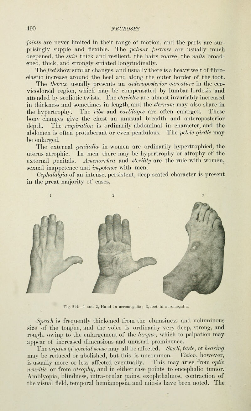 joints are never limited in their range of motion, and the parts are sur- prisingly supple and flexible. The 'palmar furrows are usually much deepened, the skin thick and resilient, the hairs coarse, the nails broad- ened, thick, and strongly striated longitudinally. The feet show similar changes, and usually there is a heavy welt of fibro- elastic increase around the heel and along the outer border of the foot. The thorax usually presents an anteroposterior curvature in the cer- vicodorsal region, which may be compensated by lumbar lordosis and attended by scoliotic twists. The clavicles are almost invariably increased in thickness and sometimes in length, and the sternum may also share in the hypertrophy. The ribs and cartilages are often enlarged. These bony changes give the chest an unusual breadth and anteroposterior depth. The 7'espiration is ordinarily abdominal in character, and the abdomen is often protuberant or even pendulous. The pelvic girdle may be enlarged. The external genitalia in women are ordinarily hypertrophied, the uterus atrophic. In men there may be hypertrophy or atrophy of the external genitals. Amenorrhea and sterility are the rule with women, sexual inappetence and impotence with men. Cephalalgia of an intense, persistent, deep-seated character is present in the great majority of cases. iT^i. ,J Fig, 214.—1 and 2, Hand in acromegalia ; 3, foot in acromegalia. Speech is frequently thickened from the clumsiness and voluminous size of the tongue, and the voice is ordinarily very deep, strong, and rough, owing to the enlargement of the larynx, ^vhich to palpation may appear of increased dimensions and unusual prominence. The organs of special sen^e may all be affected. Smell, taste, or hearing may be reduced or abolished, but this is uncommon. Vision, however, is usually more or less affected eventually. This may arise from ojitic neuritis or from atrophij, and in either case points to encephalic tumor. Amblyopia, blindness, intra-ocular pains, exophthalmos, contraction of the visual field, temporal hemianopsia, and miosis have been noted. The