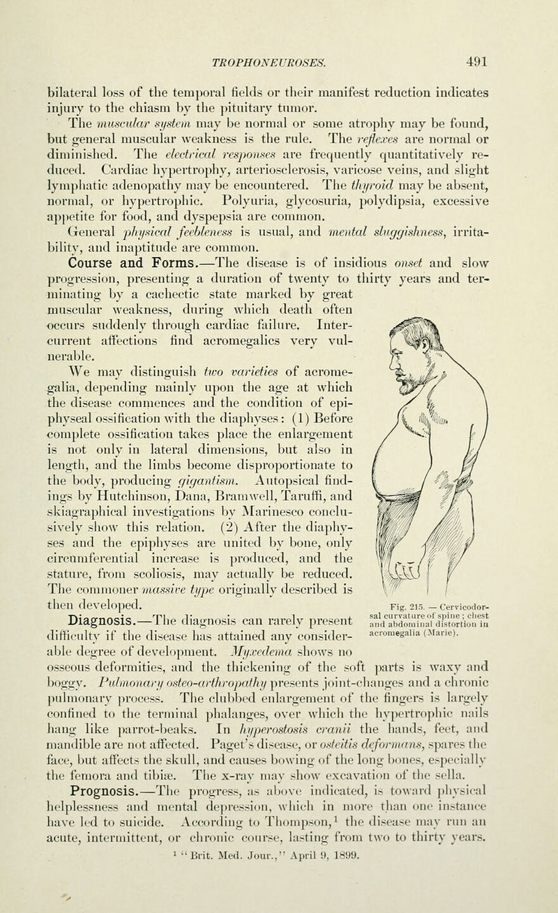 bilateral loss of the temporal fields or their manifest reduction indicates injury to the chiasm by the pituitary tumor. The muscular system may be normal or some atrophy may be found, but general muscular weakness is the rule. The reflexes are normal or diminished. The electrical responses are frequently quantitatively re- duced. Cardiac hypertrophy, arteriosclerosis, varicose veins, and slight lymphatic adenopathy may be encountered. The thyroid may be absent, normal, or hypertrophic. Polyuria, glycosuria, polydipsia, excessive appetite for food, and dyspepsia are common. General physical feebleness is usual, and mental sluggishness, irrita- bility, and inaptitude are common. Course and Forms.—The disease is of insidious onset and slow progression, presenting a duration of twenty to thirty years and ter- minating by a cachectic state marked by great muscular weakness, during which death often occurs suddenly through cardiac failure. Inter- current aifections find acromegalics very vul- nerable. We may distinguish tivo varieties of acrome- galia, depending mainly upon the age at which the disease commences and the condition of epi- physeal ossification with the diaphyses: (1) Before complete ossification takes place the enlargement is not only in lateral dimensions, but also in length, and the limbs become disproportionate to the body, producing gigantism. Autopsical find- ings by Hutchinson, Dana, Bramwell, Taruffi, and skiagraphical investigations by Marinesco conclu- sively show this relation. (2) After the diaphy- ses and the epiphyses are united by bone, only circumferential increase is produced, and the stature, from scoliosis, may actually be reduced. The commoner massive type originally described is then developed. Diagnosis.—The diagnosis can rarely present difficulty if the disease has attained any consider- able degree of development. Myxedema shows no osseous deformities, and the thickening of the soft parts is waxy and boggy. Pulmonary osteo-arthropafhy presents joint-chauges and a chronic puhuonary process. The clubbed enlargement of the fingers is largely confined to the terminal phalanges, over which the hypertrophic nails liang like parrot-beaks. In hi/perostosis cranii the hands, feet, and mandible are not aifected. Paget's disease, or osteitis deformans, spares the face, but affects the skull, and causes bowing of the long bones, especially the femora and tibiae. The x-ray may show excavation of the sella. Prognosis.—The progress, as above indicated, is toward ))hysical helplessness and mental depression, which in more than one instance have led to suicide. According to Thompson, ^ the disease may run an acute, intermittent, or chronic course, lasting from two to thirty years. 1 Brit. Med. Jour., April 9, 1899. Fig. 215, — Cervicodor- sal curvature of spine ; chest and abdominal distortion in acromegalia (Marie).