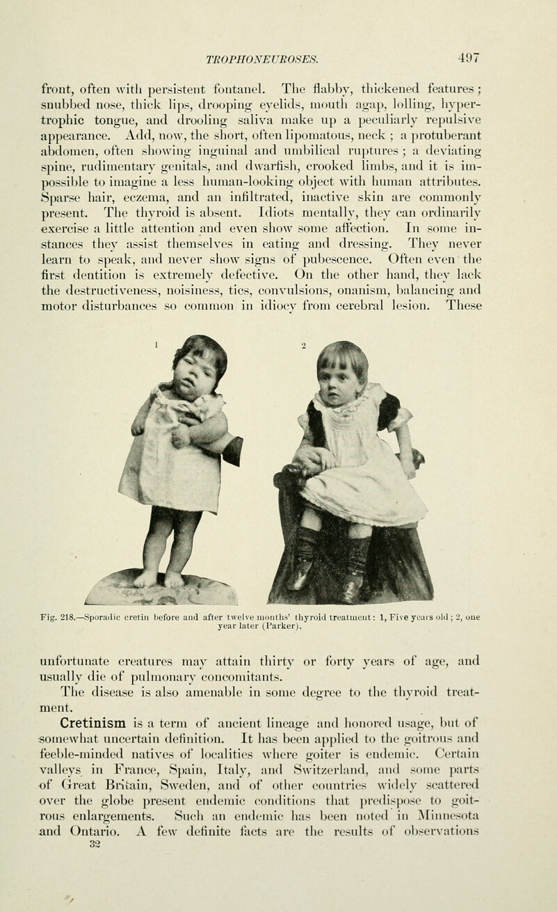 front, often with persistent fontanel. The flabby, thickened features; snubbed nose, thick Hps, drooping eyelids, mouth agap, lolling, hyper- trophic tongue, and drooling saliva make up a peculiarly repulsive appearance. Add, now, the short, often lipomatous, neck ; a protuberant abdomen, often showing inguinal and umbilical ruptures ; a deviating spine, rudimentary genitals, and dwarfish, crooked limbs, and it is im- possible to imagine a less human-looking object with human attributes. Sparse hair, eczema, and an infiltrated, inactive skin are commonly present. The thyroid is absent. Idiots mentally, they can ordinarily exercise a little attention and even show some affection. In some in- stances they assist themselves in eating and dressing. They never learn to speak, and never show signs of pubescence. Often even the first dentition is extremely defective. On the other hand, they lack the destructiveness, noisiness, tics, convulsions, onanism, balancing and motor disturbances so common in idiocy from cerebral lesion. These Tig. 218.—Sporadic cretin before and after twelve months' thyroid treatment; 1, Five years old ; 2, oue year later (Parker). unfortunate creatures may attain thirty or forty years of age, and usually die of pulmonary concomitants. The disease is also amenable in some degree to the thyroid treat- ment. Cretinism is a term of ancient lineage and honored usage, but of somewhat uncertain definition. It has been applied to the goitrous and feeble-minded natives of localities where goiter is endemic. Certain valleys in France, Spain, Italy, and Switzerland, and some parts of Great Britain, Sweden, and of other countries widely scattered over the globe present endemic conditions that predispose to goit- rous enlargements. Sucli ati endemic has been noted in Minnesota and Ontario. A few definite facts are the results of observations 32