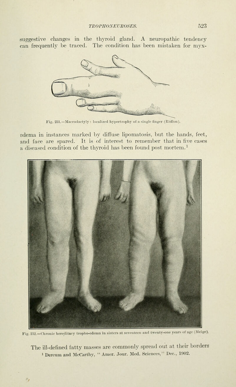 suggestive changes in the thyroid gland. A neuropathic tendency can frequently be traced. The condition has been mistaken for myx- Fig. 231.—Macrodactyly : localized hypertrophy of a single finger (Ridlon). edema in instances marked by diffuse lipomatosis, but the hands, feet, and face are spared. It is of interest to remember that in five cases a diseased condition of the thyroid has been found post mortem.^ Fig. 2:32.—riiroriic liereditary troplio-edema in sisters at seventeen and twenty-one years of age (.Meige). The ill-defined fatty masses are commonly spread out at their borders 1 Dercuni aud ^McCarthy,  Amer. Jour. Med. Sciences, Dec, 1902.