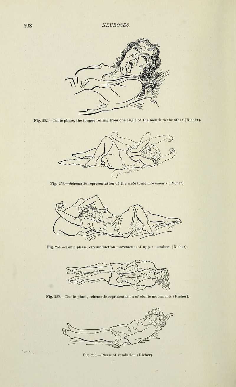 Fig. 252.—Tonic phase, the tongue rolling from one angle of the mouth to the other (Richer). Fig. 253.—Schematic representation of the wii!e tonic movements (Richer). Fig. 254.—Tonic phase, cLrcumduction movements of upper members (Richer). Fig. 255.—Clonic phase, schematic representation of clonic movements (Richer). Fig. 256.—Phase of resolutiou (Richer).