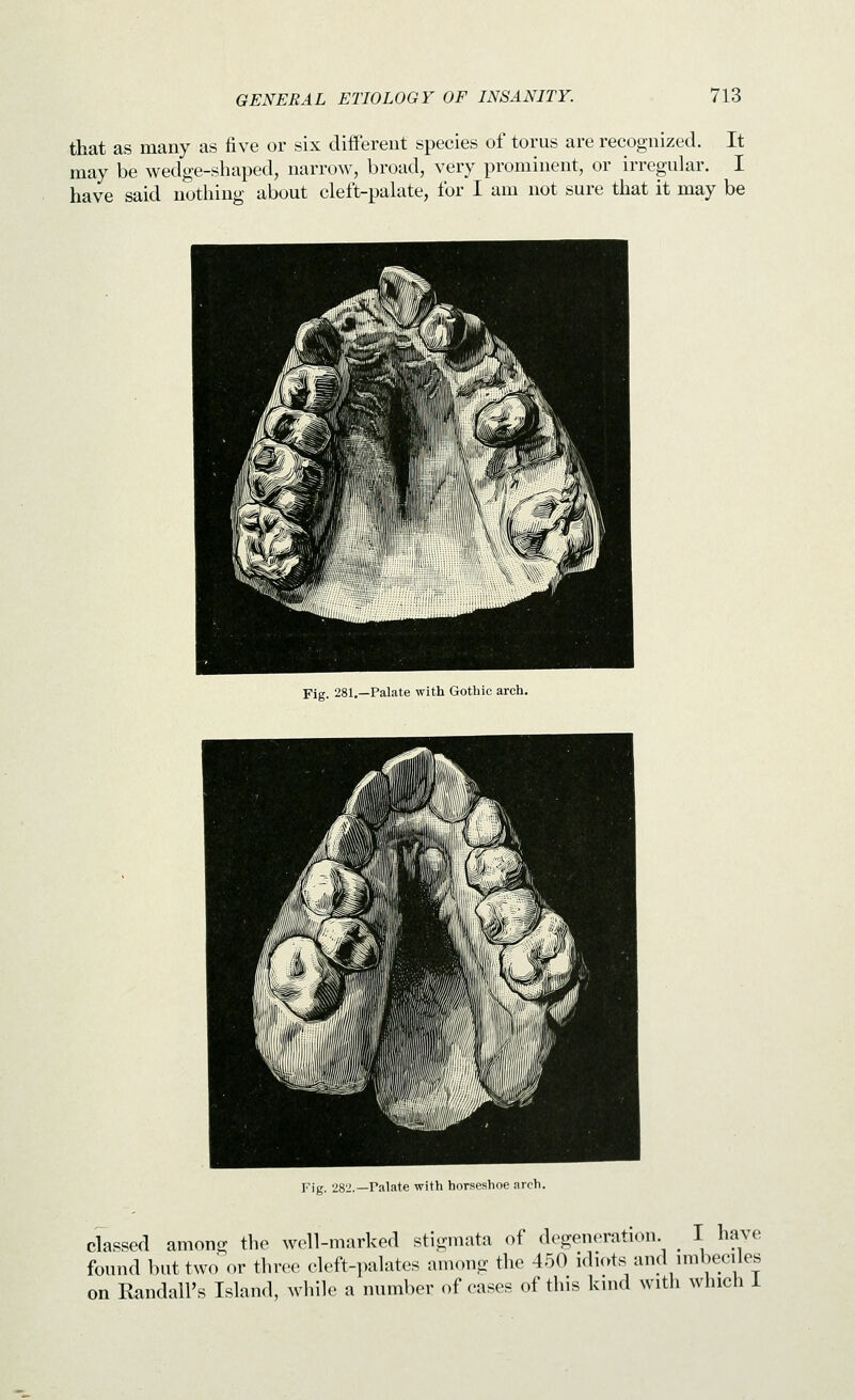 that as many as five or six diiferent species of torus are recognized. It may be wedge-sliaped, narrow, broad, very prominent, or irregular. I have said nothing about cleft-palate, for I am not sure that it may be Fig. 281,—Palate with Gotbic arch. Fig. 282.—Palate with horseshoe arch. classed among the Avcll-marked stigmata of degeneration _ I have found but two or three cleft-palates among the 450 idiots and imbeciles on Randall's Island, wliile a number of cases of this kind with which i