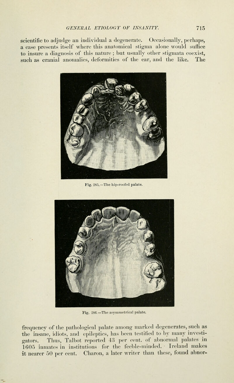 scientific to adjudge an individual a degenerate. Occasionally, perhaps, a case presents itself where this anatomical stigma alone would suffice to insure a diagnosis of this nature; but usually other stigmata coexist, such as cranial anomalies, deformities of the ear, and the like. The Fig. 285.—The hip-roofed palate. Fig. 286.—The asymmetrical palate. frequency of the pathological palate among marked degenerates, such as the insane, idiots, and epileptics, has been testified to by many investi- gators. Thus, Talbot reported 43 i)er cent, of abnormal palates in 1605 inmates in institutions for the feeble-minded. - Ireland makes it nearer 50 per cent. Charon, a later writer than these, found abnor-