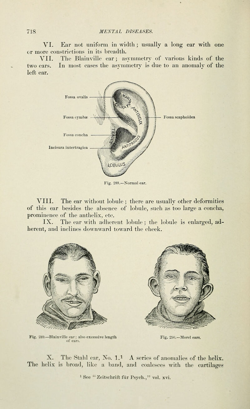 VI. Ear not uniform in width; usually a long ear with one or more constrictions in its breadth. VII. The Blainville ear; asymmetry of various kinds of the two ears. In most cases the asymmetry is due to an anomaly of the left ear. Fossa ovalis Fossa cymbae V-i^^wi Fossa concha Incisura intertragica Fossa scaphoidea Fig. 288.—Normal ear. VIII. The ear without lobule ; there are usually other deformities of this ear besides the absence of lobule, such as too large a concha, prominence of the anthelix, etc. IX. The ear with adherent lobule ; the lobule is enlarged, ad- herent, and inclines downward toward the cheek. Fig. 289.—Blainville ear; also excessive length of ears. Fig. 290.—Jlorel ears. X. The Stahl ear, Xo. l.i A series of anomalies of the helix. The helix is broad, like a l)and, and coalesces with the cartilages 1 See Zeitschrift fiir Psych., vol. xvi.