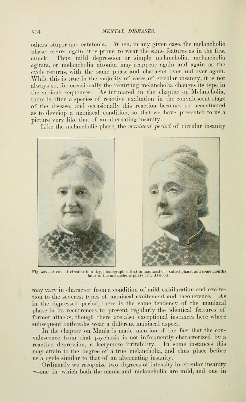 others stupor and catatonia. When, in any given case, the melancholic phase recurs again, it is prone to wear the same features as in the first attack. Thus, mild depression or simple melancholia, melancholia agitata, or melancholia attonita may reappear again and again as the cycle returns, with the same phase and character over and over again. While this is true in the majority of cases of circular insanity, it is not always so, for occasionally the recurring melancholia changes its type in the various sequences. As intimated in the chapter on Melancholia, there is often a species of reactive exaltation in the convalescent stage of the disease, and occasionally this reaction becomes so accentuated as to develop a maniacal condition, so that we have presented to us a picture very like that of an alternating insanity. Like the melancholic phase, the maniacal period of circular insanity Fig. 308.—A case of circular insanity, pliotographed first in maniacal or exalted phase, and some months later in the melancholic phase (Dr. Atwoodj. may vary in character from a condition of mild exhilaration and exalta- tion to the severest types of maniacal excitement and incoherence. As in the depressed period, there is the same tendency of the maniacal phase in its recurrences to present regularly the identical features of former attacks, though tliere are also exceptional instances here where subsequent outbreaks wear a different maniacal aspect. In the chapter on Mania is made mention of the fact that the con- valescence from that psychosis is not infrequently characterized by a reactive depression, a lacrymose irritability. In some instances this may attain to the degree of a true melancholia, and thus place before us a cycle similar to that of an alternating insanity. Ordinarily we recognize two degrees of intensity in circular insanity -=-one in which both the mania and melancholia are mild, and one in