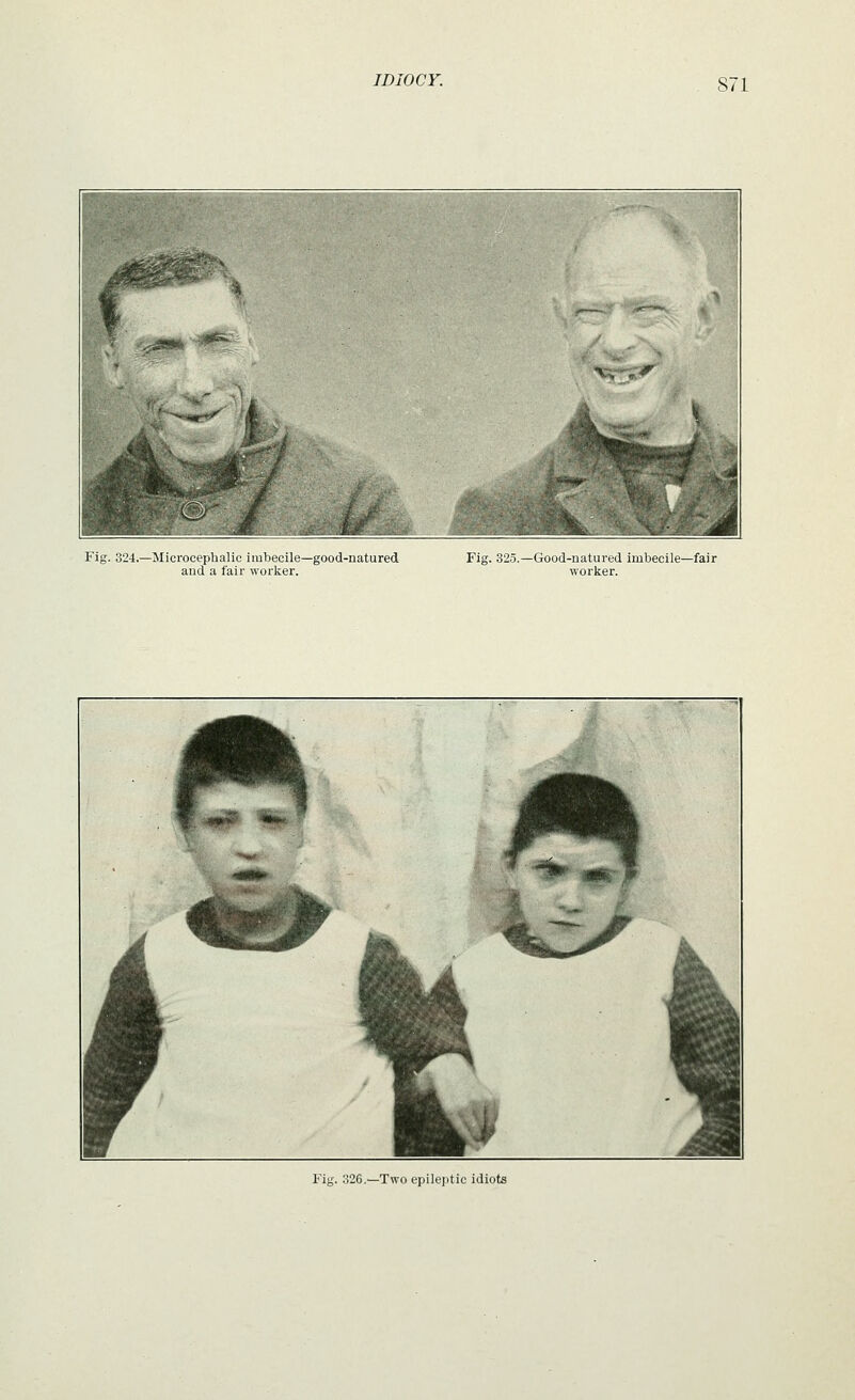 Fig. 324.—Microcephalic imbecile—good-natured aud a fair worker. Fig. 325.—Good-natured imbecile—fair worker. Fig. 326.—Two epilejitic idiots