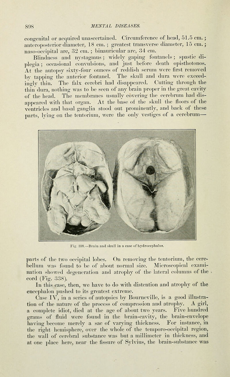 congenital or acquired unascertained. Circumference of head, 51.5 cm.; anteroposterior diameter, 18 cm. ; greatest transverse diameter, 15 cm.; naso-occipital arc, 32 cm. ; binauricular arc, 34 cm. Blindness and nystagmus; widely gaping fontanels; spastic di- plegia ; occasional convulsions, and just before death opisthotonos. At the autopsy sixty-four ounces of reddish serum were first removed by tapping the anterior fontanel. The skull and dura were exceed- ingly thin. The falx cerebri had disappeared. Cutting through the thin dura, nothing was to be seen of any brain proper in the great cavity of the head. The membranes usually covering the cerebrum had dis- appeared with that organ. At the base of the skull the floors of the ventricles and basal ganglia stood out prominently, and back of these parts, lying on the tentorium, were the only vestiges of a cerebrum—■ Fig. 338.—Brain and skull in a case of hydrocephalus. parts of the two occipital lobes. On removing the tentorium, the cere- bellum was found to be of about normal size. Microscopical exami- nation showed degeneration and atrophy of the lateral columns of the cord (Fig. 338). In this case, then, we have to do with distention and atrophy of the encephalon pushed to its greatest extreme. Case IV, in a series of autopsies by Bourneville, is a good illustra- tion of the nature of the process of compression and atrophy. A girl, a complete idiot, died at the age of about two years. Five hundred grams of fluid were found in the brain-cavity, the brain-envelope having become merely a sac of varying thickness. For instance, in the right hemisphere, over the whole of the temporo-occipital region, the wall of cerebral substance was but a millimeter in thickness, and at one place here, near the fissure of Sylvius, the brain-substance was