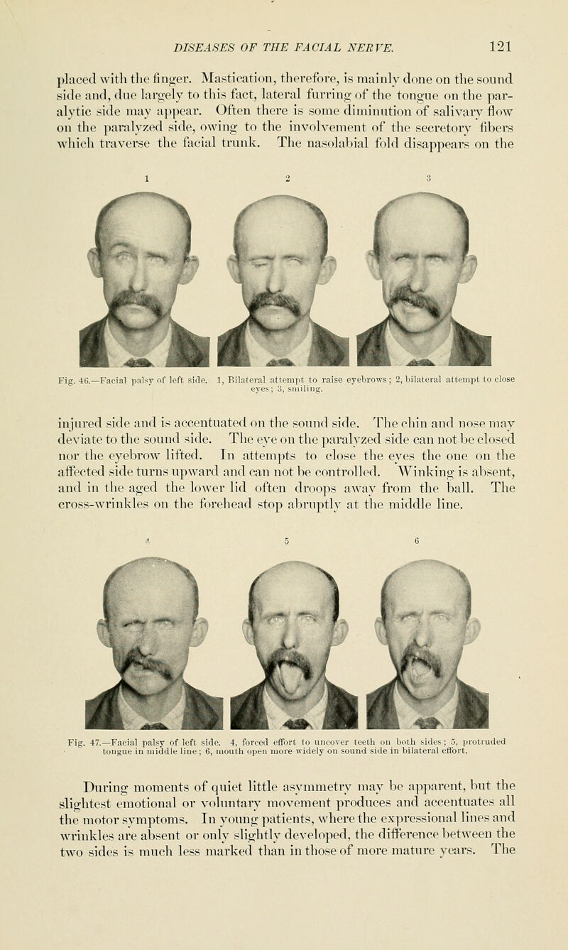 placed with the finger. Mastication, therefore, is mainly done on the sound side and, due largely to this fact, lateral furring of the tongue on the par- alytic side may appear, (^ftcn there is some diminution of salivary flow on the paralyzed side, owing to the involvement of the secretory fibers which traverse the facial trunk. The nasolabial fold disappears on the Fig. 46.—Facial palsy of left side. 1, Bilateral attempt to raise eyebrows; 2, bilateral attempt to close eyes; 3, smiling. injured side and is accentuated on the sound side. The chin and nose may deviate to the sound side. The eye on the paralyzed side can not be closed nor the eyebrow lifted. In attempts to close the eyes the one on the affected side turns upward and can not be controlled. Winking is absent, and in the aged the lower lid often droops away from the ball. The cross-wrinkles on the forehead stop abruptly at the middle line. Fig. 47.—Facial palsy of left side. 4, forced effort to uncover teeth on both sides; 5, protruded tongue in middle line; 6, mouth open more widely on sound side in bilateral effort. During moments of quiet little asymmetry may be apparent, but the slightest emotional or voluntary movement produces and accentuates all the motor symptoms. In young patients, where the expressional lines and wrinkles are al3sent or only slightly developed, the difference between the two sides is much less marked than in those of more mature years. The