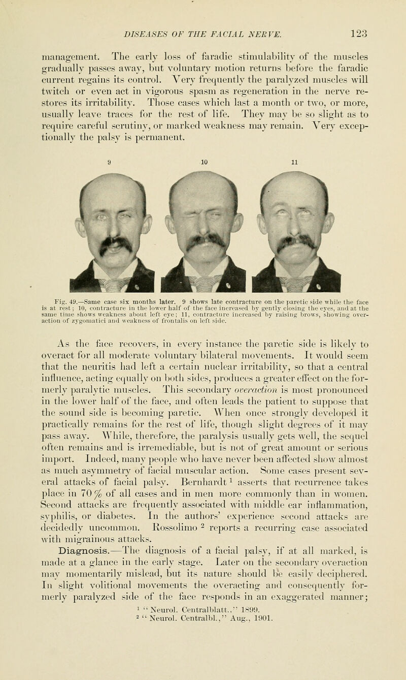 management. The early loss of faradic stimulability of the muscles gradually passes away, but voluntary motion returns before the faradic current regains its control. Very frequently the paralyzed muscles will twitch or even act in vigorous spasm as regeneration in the nerve re- stores its irritability. Those cases which last a month or two, or more, usually leave traces for the rest of life. They may be so slight as to require careful scrutiny, or marked weakness may remain. A^ery excep- tionally the palsy is permanent. Fig. 49.—Same ease six months later. 9 shows late contracture on the jiaretio side while the face is at rest; 10, contracture in the lower half of the face increased by gently closing the eyes, and at the same time shows weakness about left eye; 11, contracture increased by raising brows, showing over- action of zygomatic! and weakness of frontalis on left side. As the face recovers, in every instance the paretic side is likely to overact for all moderate voluntary bilateral movements. It would seem that the neuritis had left a certain nuclear irritability, so that a central influence, acting equally on both sides, produces a greater effect on the for- merly paralytic muscles. This secondary overaction is most pronounced in the lower half of the face, and often leads the patient to suppose that the sound side is becoming paretic. When once strongly developed it practically remains for the rest of life, though slight degrees of it may pass away. While, therefore, the paralysis usually gets well, the sequel often remains and is irremediable, but is not of great amount or serious import. Indeed, many people who have never been aifected show almost as much asymmetry of facial muscular action. Some cases present sev- eral attacks of facial palsy. Bernhardt ^ asserts that recurrence takes place in 70^ of all cases and in men more commonly than in women. Second attacks are frequently associated with middle ear inflammation, syphilis, or diabetes. In the authors' experience second attacks are decidedly uncommon. Rossolimo ^ reports a recurring case associated with migrainous attacks. Diagnosis.—The diagnosis of a facial palsy, if at all marked, is made at a glance in the early stage. Later on the secondary overaction may momentarily mislead, but its nature should be easily deciphered. In slight volitional movements the overacting and consequently for- merly paralyzed side of the face responds in an exaggerated manner; 1 Neurol. Ceiitralblatt., 1899. 2 Neurol. Centralbl., Aug., 1901.