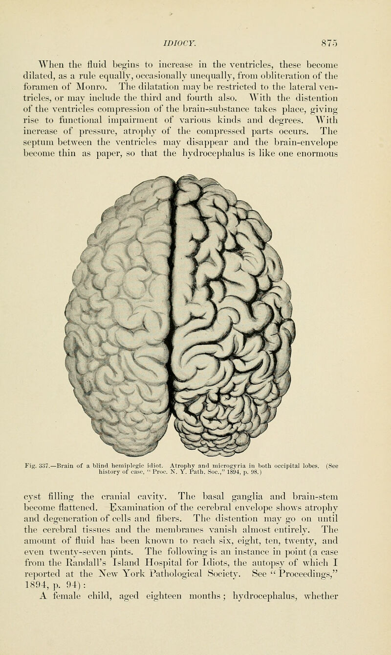 When the fin id begins to increase in the ventricles, these become dihited, as a rule equally, oeeasionally unequally, from obliteration of the foramen of Monro. The dilatation may be restricted tt> the lateral ven- tricles, or may include the third and fourth also. With the distention of the ventricles compression of the brain-substance takes place, giving rise to functional impairment of various kinds and degrees. With increase of pressure, atrophy of the compressed parts occurs. The septum between the ventricles may disappear and the brain-envelope become thin as paper, so that the hydrocephalus is like one enormous Fig. 337.—Brain of a blind heraiplegie idiot. Atrophy and microgyria in both occipital lobes. (See history of case,  Proc. N. Y. Path. Soc, 1894, p. 98.) cyst filling the cranial cavity. The basal ganglia and brain-stem become flattened. Examination of the cerebral envelope shows atrophy and degeneration of cells and fibers. The distention may go on until the cerebral tissues and the membranes vanish almost entirely. The amount of fluid has been known to reach six, eight, ten, twenty, and even twenty-seven pints. The following is an instance in point (a case from the Randall's Island Hospital for Idiots, the autopsy of wdiich I reported at the New York Pathological Society. See  Proceedings, 1894, p. 94) : A female child, aged eighteen months; hydrocephalus, whether