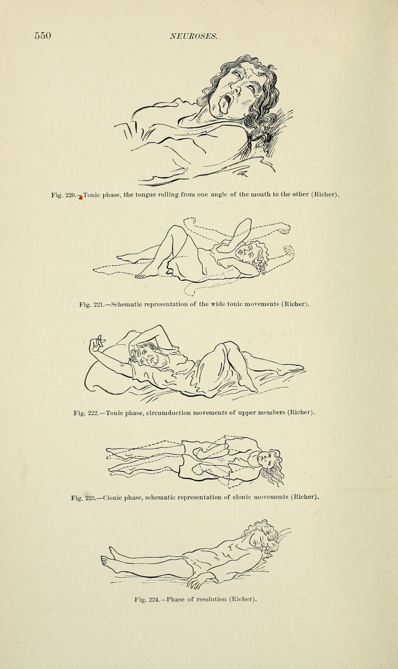 Fig. 220,-jTonic phase, the tongue rolling from one angle of the mouth to the other (Richer). Fig. 221.—Schematic representation of the wide tonic movements (Richer). Fig. 222.—Tonic phase, circumduction movements of upper members (Richer). Fig. 223.—Clonic phase, schematic representation of clonic movements (Richer). Fig. 224.—Phase of resolution (Richer).