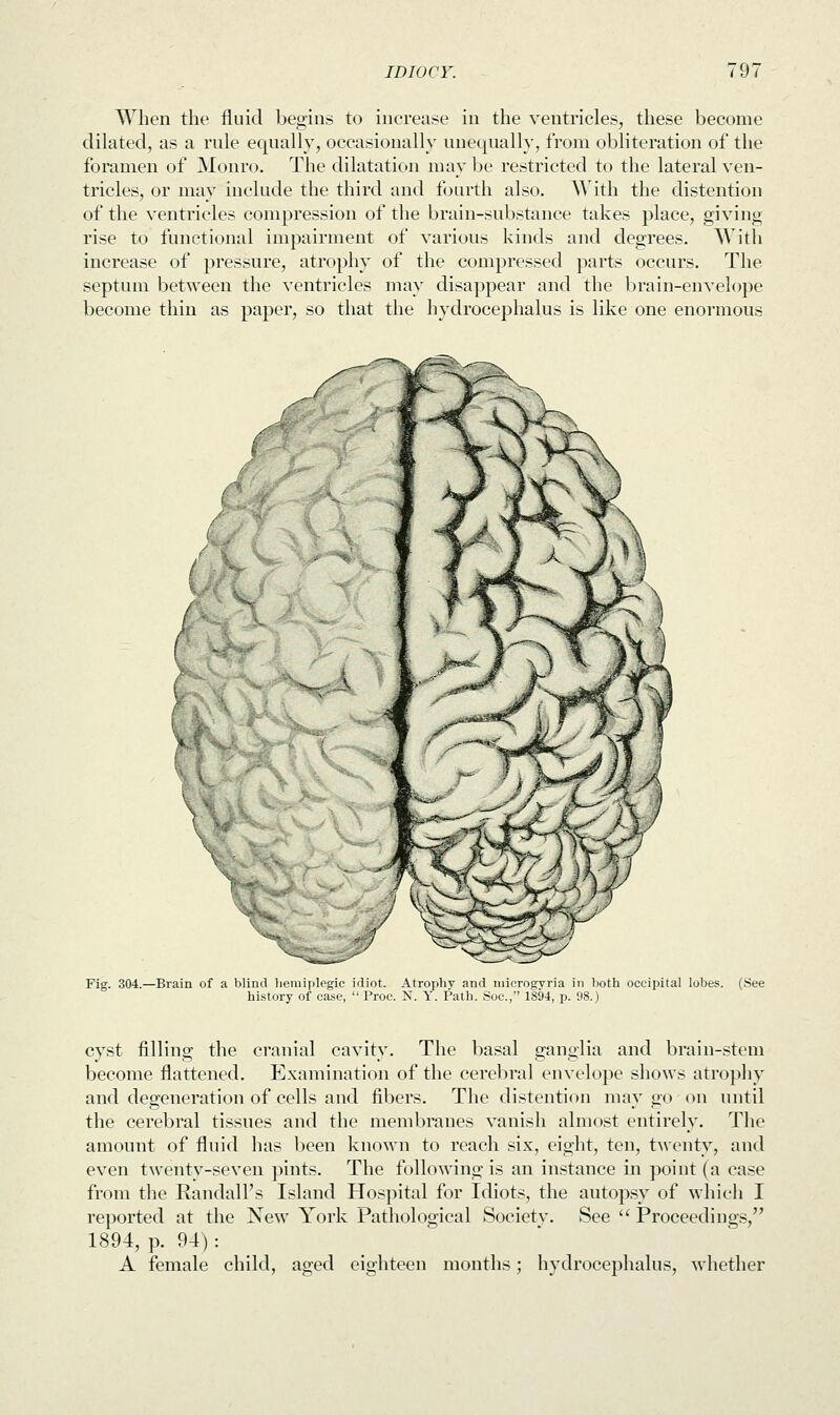 When the fluid begins to increase in the ventricles, these become dilated, as a rule equally, occasionally unequally, from obliteration of the foramen of Monro. The dilatation may be restricted to the lateral ven- tricles, or may include the third and fourth also. With the distention of the ventricles compression of the brain-substance takes place, giving rise to functional impairment of various kinds and degrees. Witli increase of pressure, atrophy of the compressed parts occurs. The septum between the ventricles may disappear and the brain-envelope become thin as paper, so that the hydrocephalus is like one enormous mM # Fig. 304.—Brain of a blind hemiplegie idiot. Atrophv and microgyria in both occipital lobes. (See history of case,  Proc. N. Y. Path. Soc, 1894, p. 98.) cyst filling the cranial cavity. The basal ganglia and brain-stem become flattened. Examination of the cerebral envelope shows atrophy and degeneration of cells and fibers. The distention may go on until the cerebral tissues and the membranes vanish almost entirely. The amount of fluid has been known to reach six, eight, ten, twenty, and even twenty-seven pints. The following is an instance in point (a case from the Randall's Island Hospital for Idiots, the autopsy of which I reported at the New York Pathological Societv. See  Proceedings, 1894, p. 94) : A female child, aged eighteen months; hydrocephalus, whether