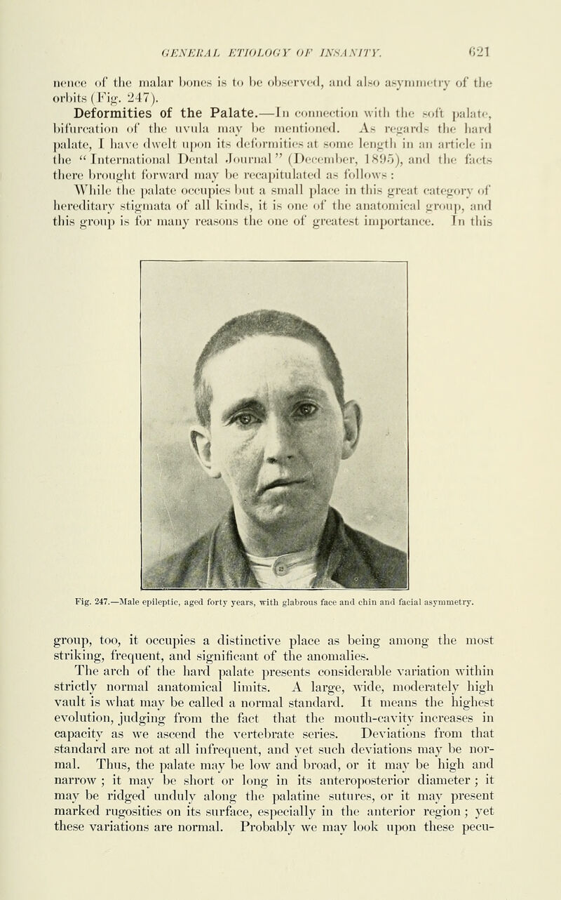 oence of the malar bones is to be observed, and also asymmetry of the orbits (Fig. 247). Deformities of the Palate.—In connection with the soft palate, bifurcation of the uvula may be mentioned. As regards the bard palate, I have dwelt upon its deformities at some length in an article in the International Dental Journal (December, 1895), and the facts there brought forward may be recapitulated as follows : While the palate occupies but a small place in this great category of hereditary stigmata of all kinds, it is one of the anatomical group, and this group is for many reasons the one of greatest importance. In this Fig. 247.—Male epileptic, aged forty years, with glabrous face and chin and facial asymmetry. group, too, it occupies a distinctive place as being among the most striking, frequent, and significant of the anomalies. The arch of the hard palate presents considerable variation within strictly normal anatomical limits. A large, wide, moderately high vault is what may be called a normal standard. It means the highest evolution, judging from the fact that the mouth-cavity increases in capacity as we ascend the vertebrate series. Deviations from that standard are not at all infrequent, and yet such deviations may be nor- mal. Thus, the palate may be low and broad, or it may be high and narrow ; it may be short or long in its anteroposterior diameter ; it may be ridged unduly along the palatine sutures, or it may present marked rugosities on its surface, especially in the anterior region; yet these variations are normal. Probably we may look upon these pecu-