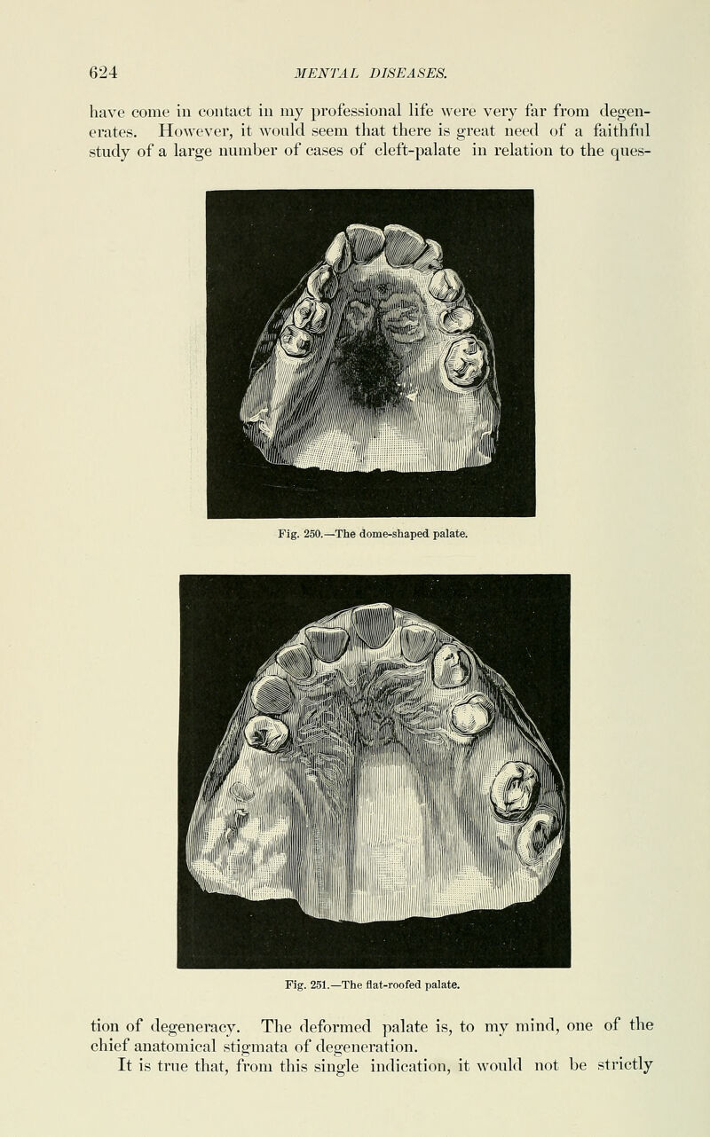 have come in contact in my professional life were very far from degen- erates. However, it would seem that there is great need of a faithful study of a large number of cases of cleft-palate in relation to the ques- Fig. 250.—The dome-shaped palate. Fig. 251.—The flat-roofed palate. tion of degeneracy. The deformed palate is, to my mind, one of the chief anatomical stigmata of degeneration. It is true that, from this single indication, it would not be strictly