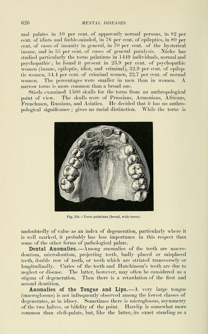 mal palates in 10 per cent, of apparently normal persons, in 82 per cent, of idiots and feeble-minded, in 76 per cent, of epileptics, in 80 per cent, of cases of insanity in general, in 70 per cent, of the hysterical insane, and in 35 per cent, of cases of general paralysis. Nacke has studied particularly the torus palatums in 1449 individuals, normal and psychopathic; he found it present in 23.9 per cent, of psychopathic women (insane, epileptic, idiot, and criminal), 32.9 per cent, of epilep- tic women, 34.4 per cent, of criminal women, 22.7 per cent, of normal women. The percentages were smaller in men than in women. A narrow torus is more common than a broad one. Stieda examined 1500 skulls for the torus from an anthropological point of view. The skulls were of Prussians, Armenians, Africans, Frenchmen, Russians, and Asiatics. He decided that it has no anthro- pological significance ; gives no racial distinction. While the torus is Fig. 254.—Torus palatinus (broad, wide torus). undoubtedly of value as an index of degeneration, particularly where it is well marked, it probably has less importance in this respect than some of the other forms of pathological palate. Dental Anomalies.—Among anomalies of the teeth are macro- dontism, microdontism, projecting teeth, badly placed or misplaced teeth, double row of teeth, or teeth which are striated transversely or longitudinally. Caries of the teeth and Hutchinson's teeth are due to neglect or disease. The latter, however, may often be considered as a stigma of degeneration. Then there is a retardation of the first and second dentition. Anomalies of the Tongue and Lips.—A very large tongue (macroglossus) is not infrequently observed among the lowest classes of degenerates, as in idiocy. Sometimes there is microglossus, asymmetry of the two halves, or bifidity of the point. Harelip is somewhat more common than cleft-palate, but, like the latter, its exact standing as a