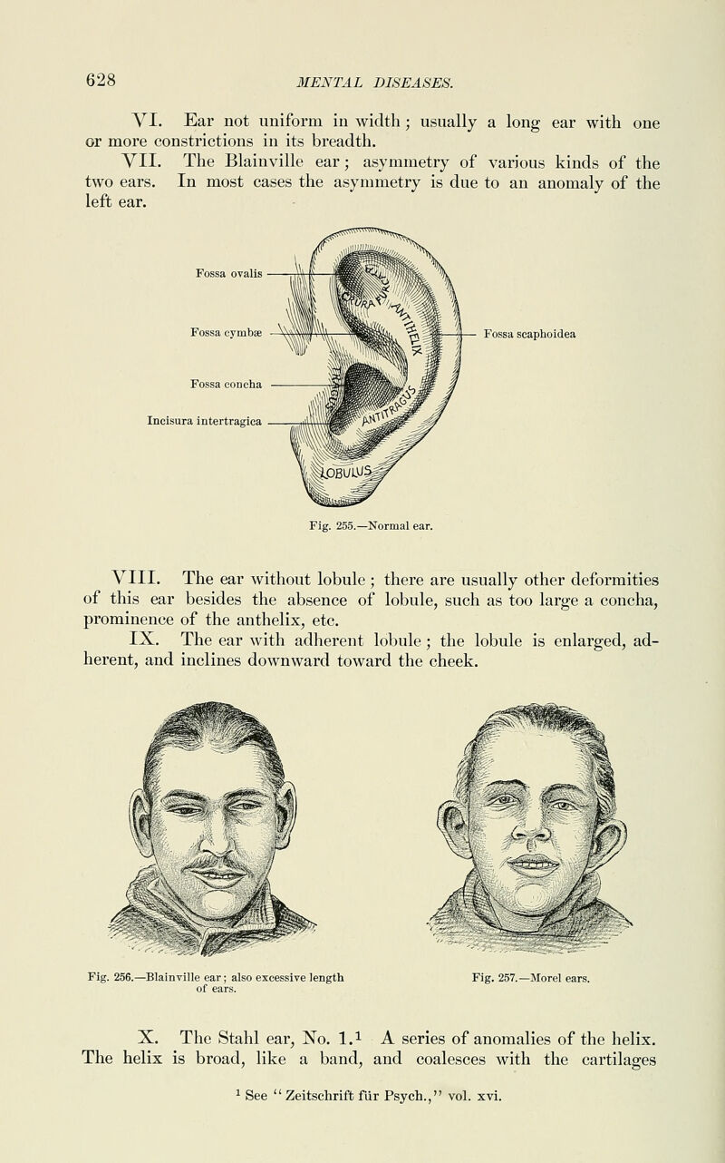 VI. Ear not uniform in width ; usually a long ear with one or more constrictions in its breadth. VII. The Blainville ear; asymmetry of various kinds of the two ears. In most cases the asymmetry is due to an anomaly of the left ear. Fossa ovalis Fossa cymbae Fossa concha Incisura intertragica Fig. 255.—Normal ear. Fossa scaphoidea VIII. The ear without lobule; there are usually other deformities of this ear besides the absence of lobule, such as too large a concha, prominence of the anthelix, etc. IX. The ear with adherent lobule ; the lobule is enlarged, ad- herent, and inclines downward toward the cheek. Fig. 256.—Blainville ear; also excessive length of ears. Fig. 257.—Morel ears. X. The Stahl ear, No. I.1 A series of anomalies of the helix. The helix is broad, like a band, and coalesces with the cartilages 1 See  Zeitschriffc fur Psych., vol. xvi.