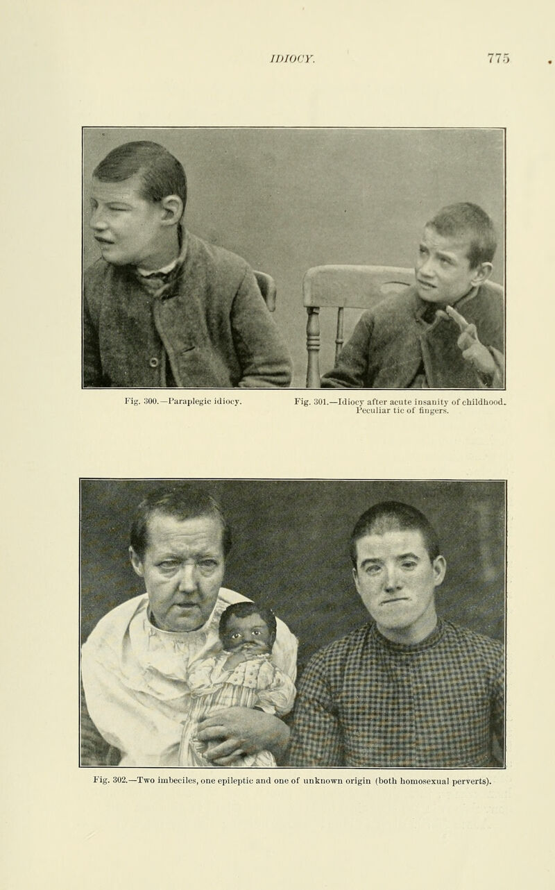 Fig. 300.— Paraplegic idiocy. Fig. 301.—Idiocy after acute insanity of childhood. Peculiar tic of fingers. Fig. 302.—Two imbeciles, one epileptic and one of unknown origin (both homosexual perverts).