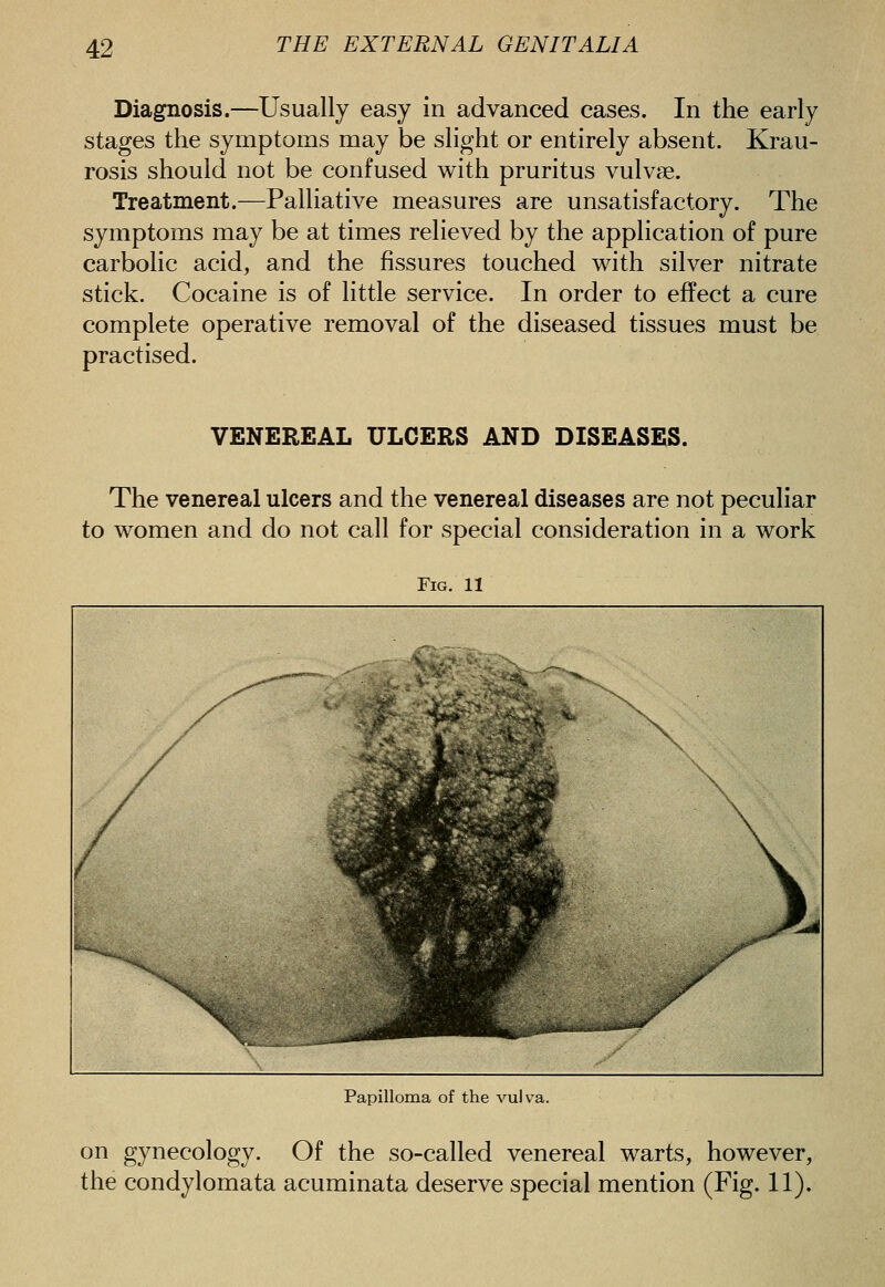 Diagnosis.—Usually easy in advanced cases. In the early stages the symptoms may be slight or entirely absent. Krau- rosis should not be confused with pruritus vulvae. Treatment.—Palliative measures are unsatisfactory. The symptoms may be at times relieved by the application of pure carbolic acid, and the fissures touched with silver nitrate stick. Cocaine is of little service. In order to effect a cure complete operative removal of the diseased tissues must be practised. VENEREAL ULCERS AND DISEASES. The venereal ulcers and the venereal diseases are not peculiar to women and do not call for special consideration in a work Fig. 11 Papilloma of the vulva. on gynecology. Of the so-called venereal warts, however, the condylomata acuminata deserve special mention (Fig. 11).