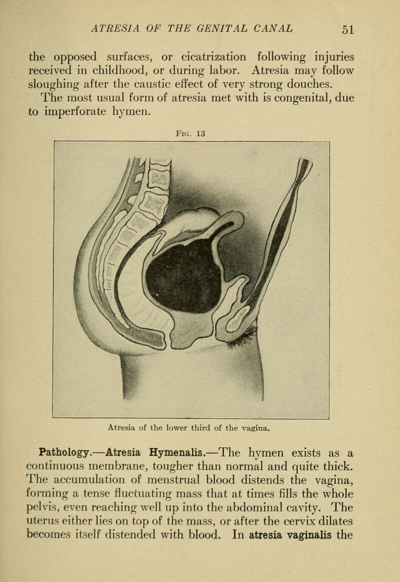 the opposed surfaces, or cicatrization following injuries received in childhood, or during labor. Atresia may follow sloughing after the caustic effect of very strong douches. The most usual form of atresia met with is congenital, due to imperforate hymen. Fig Atresia of the lower third of the vagina. Pathology.—Atresia Hymenalis.—The hymen exists as a continuous membrane, tougher than normal and quite thick. The accumulation of menstrual blood distends the vagina, forming a tense fluctuating mass that at times fills the whole pelvis, even reaching well up into the abdominal cavity. The uterus either lies on top of the mass, or after the cervix dilates becomes itself distended with blood. In atresia vaginalis the