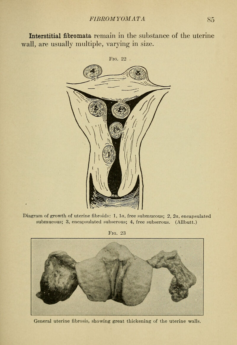 Interstitial fibromata remain in the substance of the uterine wall, are usually multiple, varying in size. Fig. 22 Diagram of growth of uterine fibroids: 1, la, free submucous; 2, 2a, encapsulated submucous; 3, encapsulated subserous; 4, free subserous. (AUbutt.) Fig. 23 General uterine fibrosis, showing great thickening of the uterine walls.