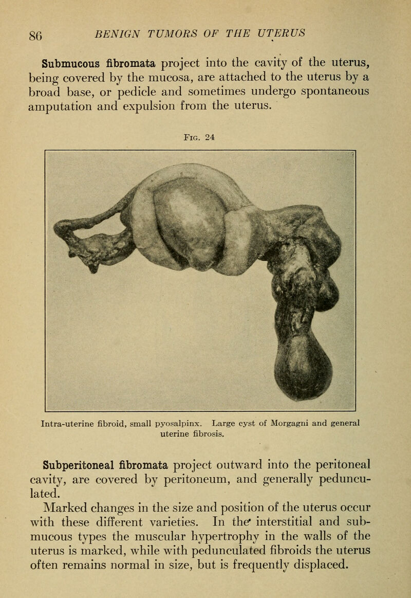 Submucous fibromata project into the cavity of the uterus, being covered by the mucosa, are attached to the uterus by a broad base, or pedicle and sometimes undergo spontaneous amputation and expulsion from the uterus. Fig. 24 Intra-uterine fibroid, small pyosalpinx. Large cyst of Morgagni and general uterine fibrosis. Subperitoneal fibromata project outward into the peritoneal cavity, are covered by peritoneum, and generally peduncu- lated. Marked changes in the size and position of the uterus occur with these different varieties. In the* interstitial and sub- mucous types the muscular hypertrophy in the walls of the uterus is marked, while with pedunculated fibroids the uterus often remains normal in size, but is frequently displaced.