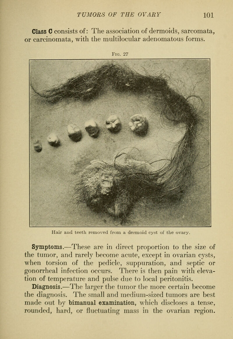 Class C consists of: The association of dermoids, sarcomata, or carcinomata, with the multilocular adenomatous forms. Fig. 27 Hair and teeth removed from a dermioid cyst of the ovary. Symptoms.—These are in direct proportion to the size of the tumor, and rarely become acute, except in ovarian cysts, when torsion of the pedicle, suppuration, and septic or gonorrheal infection occurs. There is then pain with eleva- tion of temperature and pulse due to local peritonitis. Diagnosis.—The larger the tumor the more certain become the diagnosis. The small and medium-sized tumors are best made out by bimanual examination, which discloses a tense, rounded, hard, or fluctuating mass in the ovarian region.