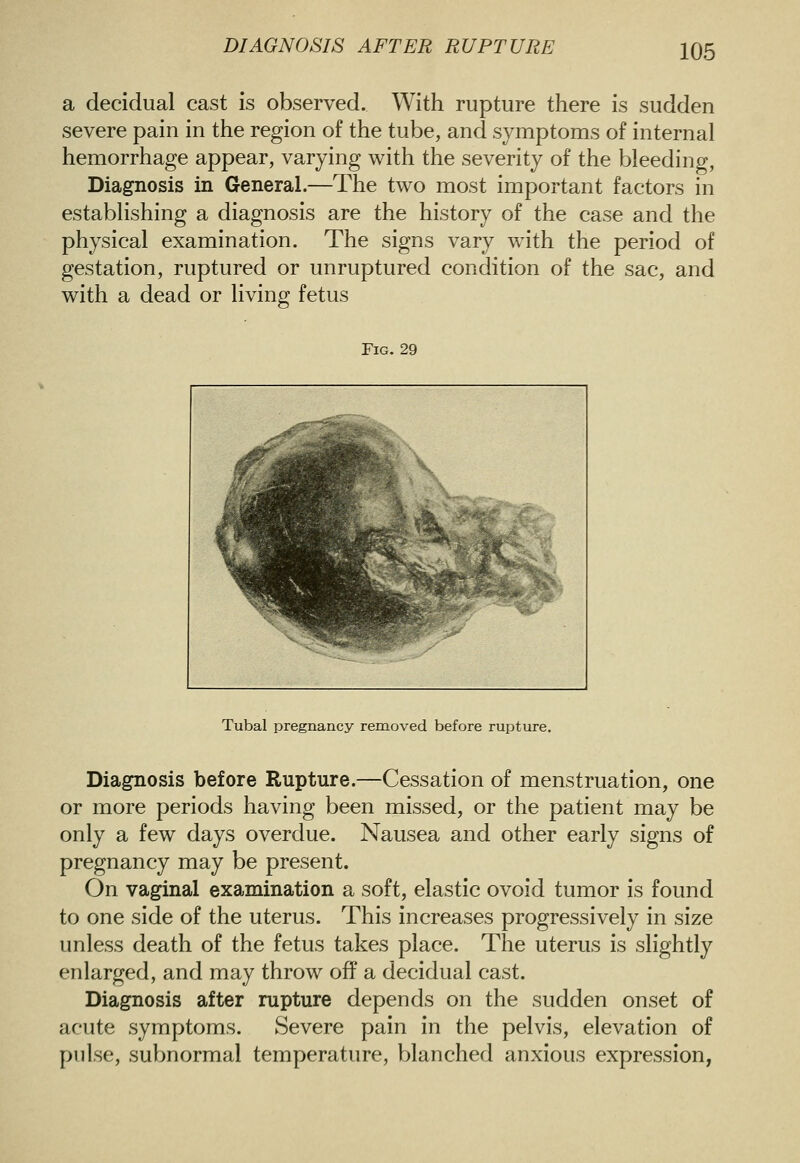 DIAGNOSIS AFTER RUPTURE a decidual cast is observed. With rupture there is sudden severe pain in the region of the tube, and symptoms of internal hemorrhage appear, varying with the severity of the bleeding, Diagnosis in General.—The two most important factors in establishing a diagnosis are the history of the case and the physical examination. The signs vary with the period of gestation, ruptured or unruptured condition of the sac, and with a dead or living fetus Fig. 29 Tubal pregnancy removed before rupture. Diagnosis before Rupture.—Cessation of menstruation, one or more periods having been missed, or the patient may be only a few days overdue. Nausea and other early signs of pregnancy may be present. On vaginal examination a soft, elastic ovoid tumor is found to one side of the uterus. This increases progressively in size unless death of the fetus takes place. The uterus is slightly enlarged, and may throw off a decidual cast. Diagnosis after rupture depends on the sudden onset of acute symptoms. Severe pain in the pelvis, elevation of pulse, subnormal temperature, blanched anxious expression,