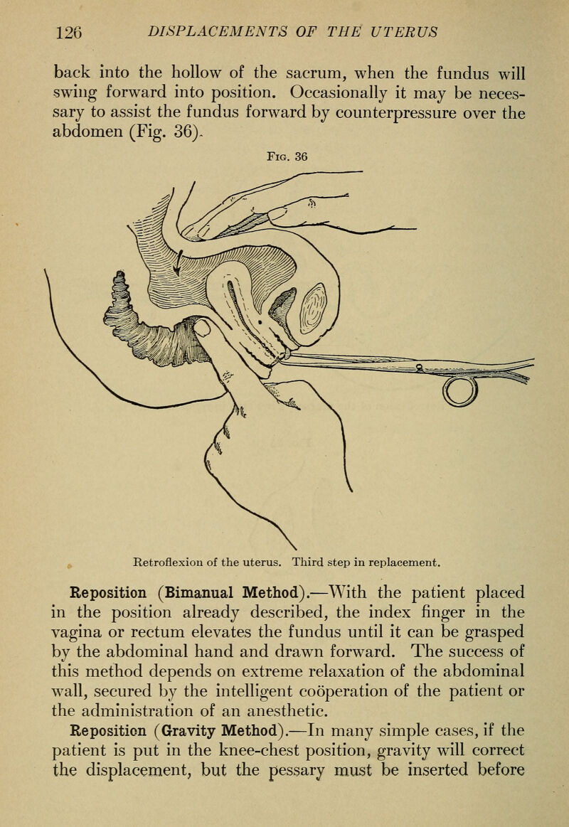 back into the hollow of the sacrum, when the fundus will swing forward into position. Occasionally it may be neces- sary to assist the fundus forward by counterpressure over the abdomen (Fig. 36)~ Fig. 36 Retroflexion of the uterus. Third step in replacement. Reposition (Bimanual Method).—With the patient placed in the position already described, the index finger in the vagina or rectum elevates the fundus until it can be grasped by the abdominal hand and drawn forward. The success of this method depends on extreme relaxation of the abdominal wall, secured by the intelligent cooperation of the patient or the administration of an anesthetic. Reposition (Gravity Method).—In many simple cases, if the patient is put in the knee-chest position, gravity will correct the displacement, but the pessary must be inserted before