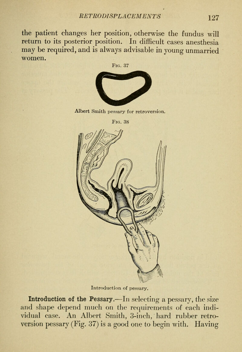 the patient changes her position, otherwise the fundus will return to its posterior position. In difficult cases anesthesia may be required, and is always advisable in young unmarried women. Fig. 37 Albert Smith pessary for retroversion. Fig. 38 Introduction of pessary. Introduction of the Pessary.—In selecting a pessary, the size and shape depend much on the recjuirements of each indi- vidual case. An All^ert Smith, 3-inch, hard rubber retro- version pessary (Fig. 37) is a good one to begin with. Having