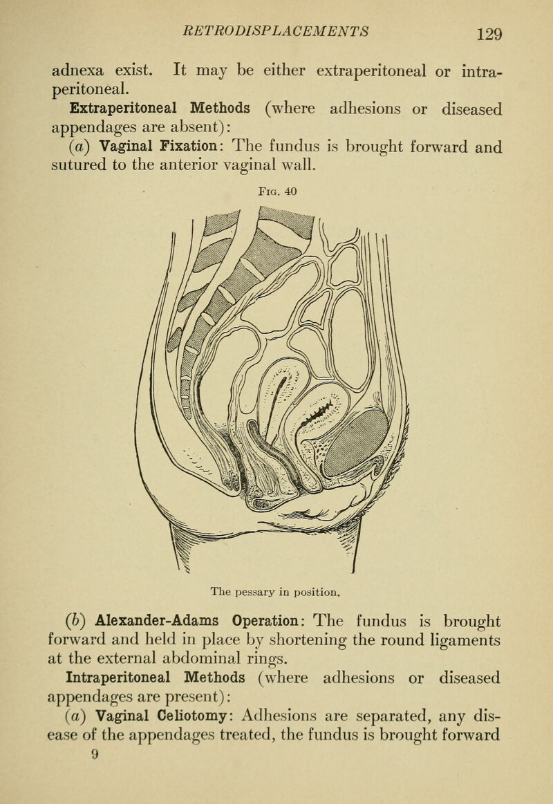 adnexa exist. It may be either extraperitoneal or intra- peritoneal. Extraperitoneal Methods (where adhesions or diseased appendages are absent): (a) Vaginal Fixation: The fundus is brought forward and sutured to the anterior vaginal wall. Fig. 40 The pessary in position, (b) Alexander-Adams Operation: The fundus is brought forward and held in place by shortening the round ligaments at the external abdominal rings. Intraperitoneal Methods (where adhesions or diseased appendages are present): (a) Vaginal Celiotomy: Adhesions are separated, any dis- ease of the appendages treated, the fundus is brought forward 9