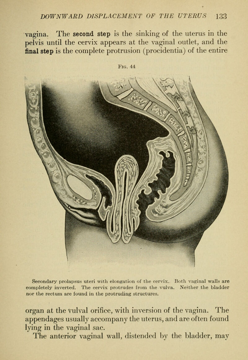 vagina. The second step is the sinking of the uterus in the pelvis until the cervix appears at the vaginal outlet, and the final step is the complete protrusion (procidentia) of the entire Fig. 44 Secondary prolapsus uteri with elongation of the cervix. Both vaginal walls are completely inverted. The cervix protrudes from the vulva. Neither the bladder nor the rectum are found in the protruding structures, organ at the vulval orifice, with inversion of the vagina. The appendages usually accompany the uterus, and are often found lying in the vaginal sac. The anterior vaginal wall, distended by the bladder, may