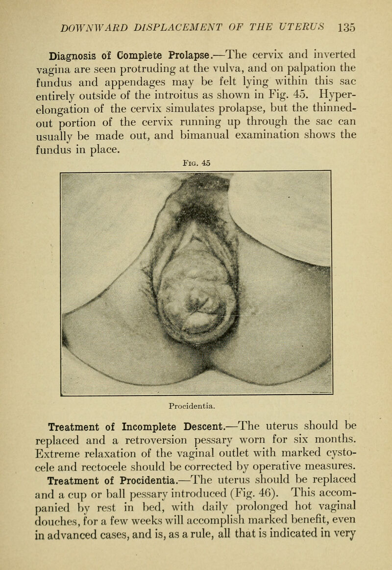 Diagnosis of Complete Prolapse.—The cervix and inverted vagina are seen protruding at the vulva, and on palpation the fundus and appendages may be felt lying within this sac entirely outside of the introitus as shown in Fig. 45. Hyper- elongation of the cervix simulates prolapse, but the thinned- out portion of the cervix running up through the sac can usually be made out, and bimanual examination shows the fundus in place. Fig. 45 Procidentia. Treatment of Incomplete Descent.—The uterus should be replaced and a retroversion pessary worn for six months. Extreme relaxation of the vaginal outlet with marked cysto- cele and rectocele should be corrected by operative measures. Treatment of Procidentia.—The uterus should be replaced and a cup or ball pessary introduced (Fig. 46). This accom- panied by rest in bed, with daily prolonged hot vaginal douches, for a few weeks will accomplish marked benefit, even in advanced cases, and is, as a rule, all that is indicated in very