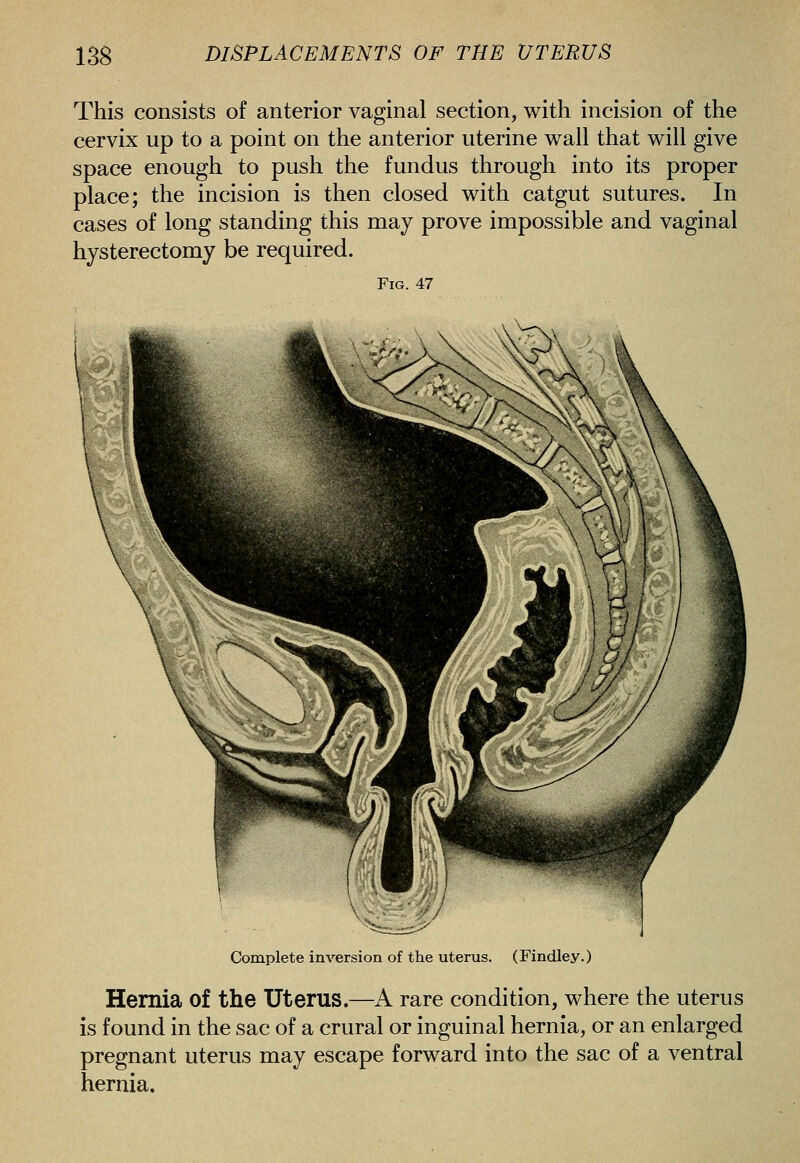 This consists of anterior vaginal section, with incision of the cervix up to a point on the anterior uterine wail that will give space enough to push the fundus through into its proper place; the incision is then closed with catgut sutures. In cases of long standing this may prove impossible and vaginal hysterectomy be required. Fig. 47 Complete inversion of the uterus. (Findley.) Hernia of the Uterus.—A rare condition, where the uterus is found in the sac of a crural or inguinal hernia, or an enlarged pregnant uterus may escape forward into the sac of a ventral hernia.