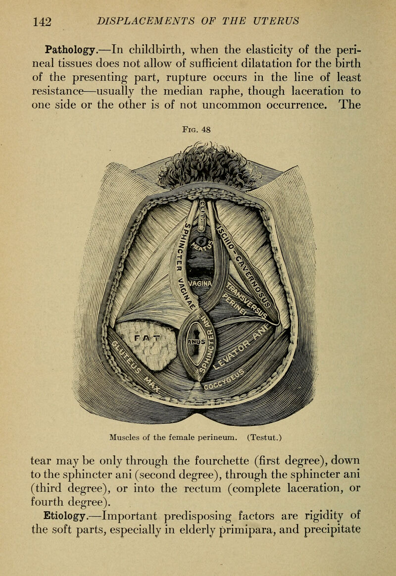 Pathology.—In childbirth, when the elasticity of the peri- neal tissues does not allow of sufficient dilatation for the birth of the presenting part, rupture occurs in the line of least resistance—usually the median raphe, though laceration to one side or the other is of not uncommon occurrence. The Fig. 48 Muscles of the female perineum. (Testut.) tear may be only through the fourchette (first degree), down to the sphincter ani (second degree), through the sphincter ani (third degree), or into the rectum (complete laceration, or fourth degree). Etiology.—Important predisposing factors are rigidity of the soft parts, especially in elderly primipara, and precipitate