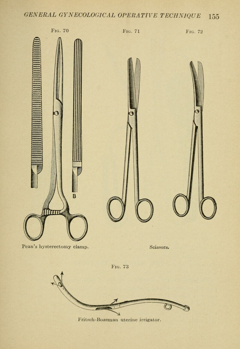 Fig. 70 Fig. 71 Fig. 72 Pcan's hysterectomy clamp. Scissors. Fig. 73 Fritsch-Bozeman uterine irrigator.