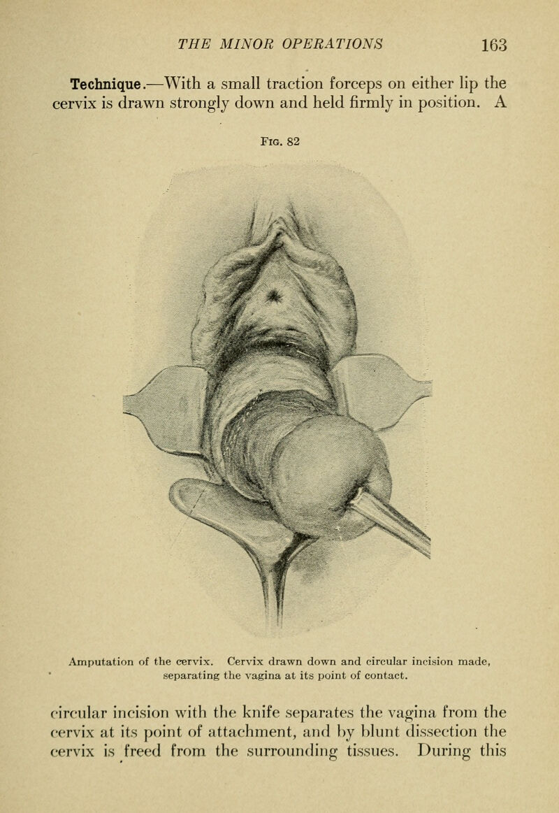 Technique.—With a small traction forceps on either lip the cervix is drawn strongly down and held firmly in position. A Fig. 82 Amputation of the cervix. Cervix drawn down and circular incision made, separating the vagina at its point of contact. circular incision with the knife separates the vagina from the cervix at its point of attachment, and })y blunt dissection the cervix is freed from the surrounding tissues. During this