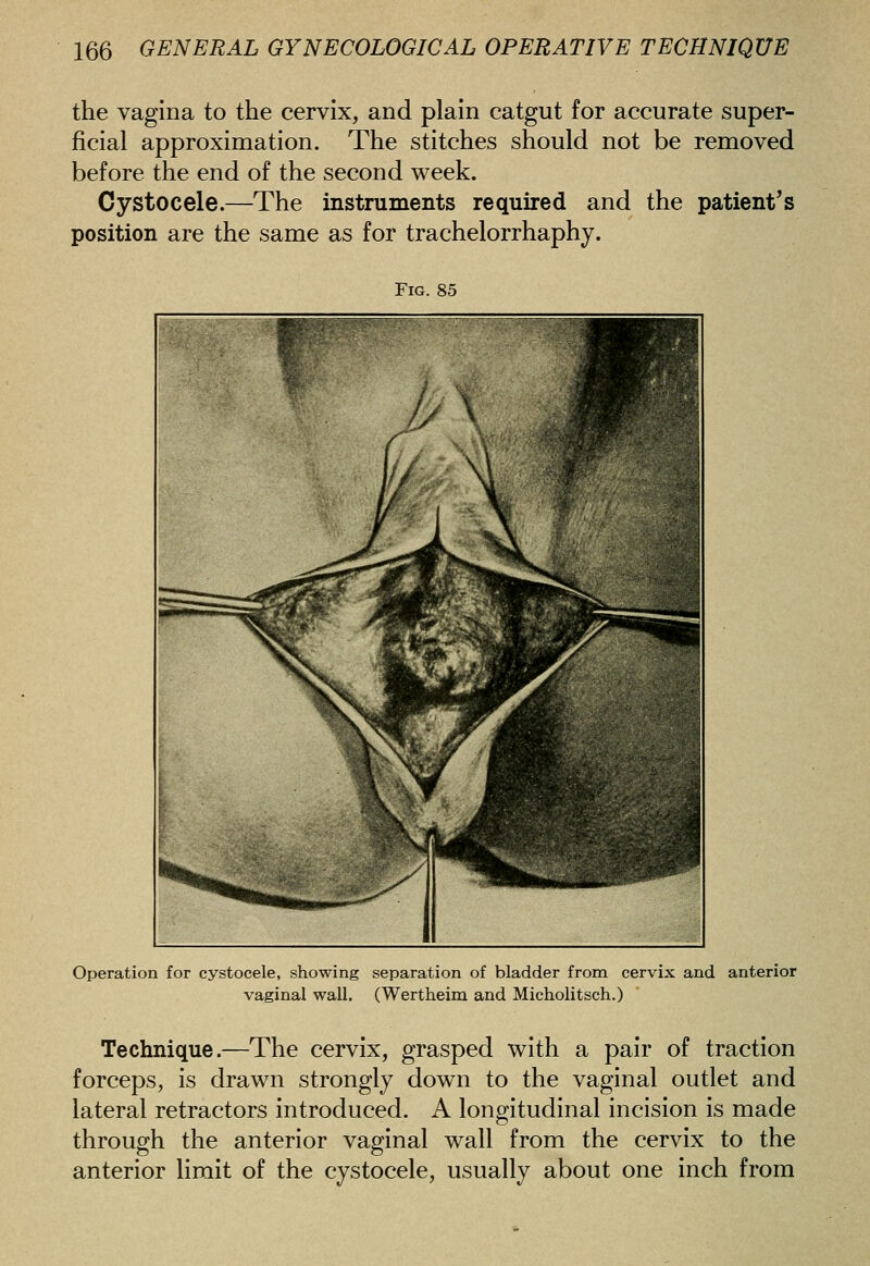 the vagina to the cervix, and plain catgut for accurate super- ficial approximation. The stitches should not be removed before the end of the second week. Cystocele.—The instruments required and the patient's position are the same as for trachelorrhaphy. Fig. 85 Operation for cystocele, showing separation of bladder from cervix and anterior vaginal wall. (Wertheim and Micholitsch.) Technique.—The cervix, grasped with a pair of traction forceps, is drawn strongly down to the vaginal outlet and lateral retractors introduced. A longitudinal incision is made through the anterior vaginal wall from the cervix to the anterior limit of the cystocele, usually about one inch from