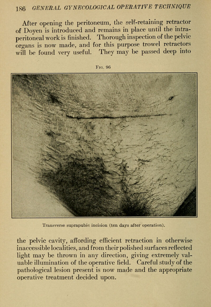 After opening the peritoneum, the self-retaining retractor of Doyen is introduced and remains in place until the intra- peritoneal work is finished. Thorough inspection of the pelvic organs is now made, and for this purpose trowel retractors will be found very useful. They may be passed deep into Fig. 96 Transverse suprapubic incision (ten days after operation). the pelvic cavity, affording efficient retraction in otherwise inaccessible localities, and from their polished surfaces reflected light may be thrown in any direction, giving extremely val- uable illumination of the operative field. Careful study of the pathological lesion present is now made and the appropriate operative treatment decided upon.