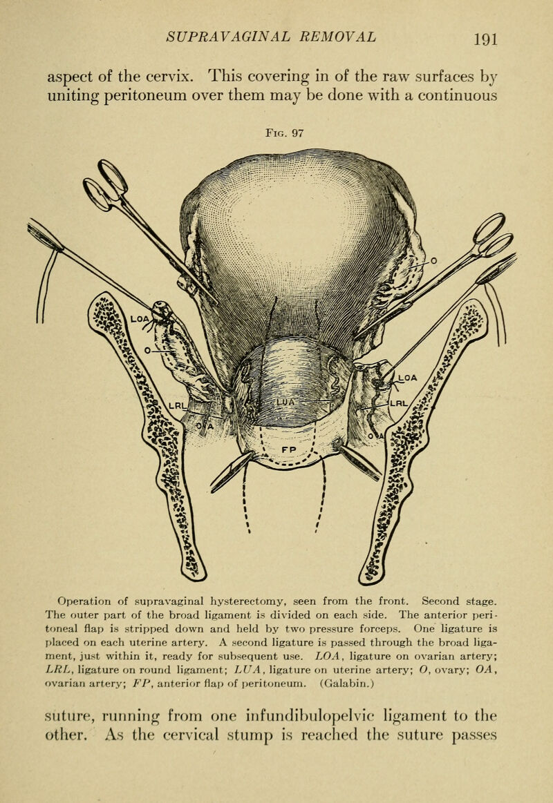 aspect of the cervix. This covering in of the raw surfaces by uniting peritoneum over them may be done with a continuous Fig. 97 Operation of supravaginal hysterectomy, seen from the front. Second stage. The outer part of the broad ligament is divided on each side. The anterior peri- toneal flap is stripped down and held by two pressure forceps. One ligature is placed on each uterine artery. A second ligature is passed through the broad liga- ment, just within it, ready for subsequent use. LOA, ligature on ovarian artery; L/^L, ligature on round ligament; />[//!, ligature on uterine artery; O, ovary; OA, ovarian artery; FP, anterifir flaj) of peritoneum. (Galabin.) suture, running from one infundibulopelvic hgament to the other. As the cervical stump is reached the suture passes