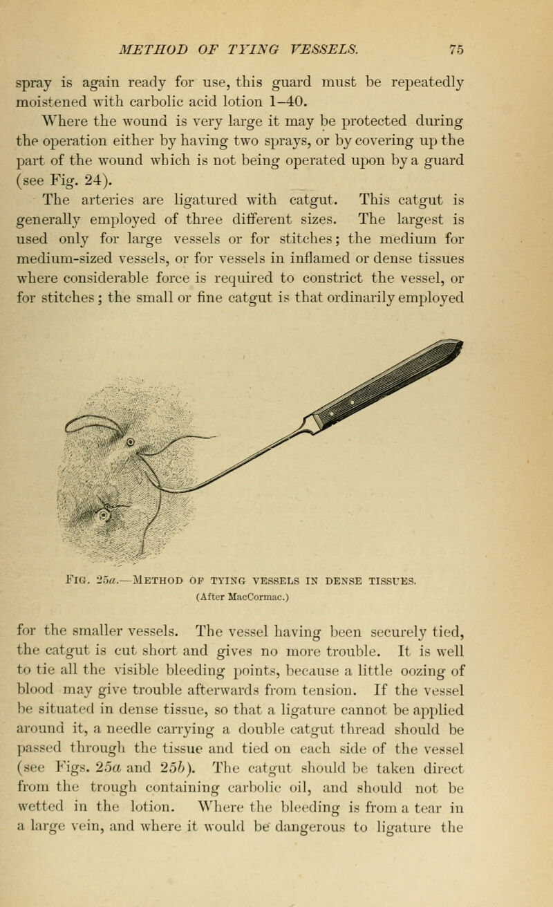 spray is again ready for use, this guard must be repeatedly moistened with carbolic acid lotion 1-40. Where the wound is very large it may be protected during the operation either by having two sprays, or by covering up the part of the wound which is not being operated upon by a guard (see Fig. 24). The arteries are ligatured with catgut. This catgut is generally employed of three different sizes. The largest is used only for large vessels or for stitches; the medium for medium-sized vessels, or for vessels in inflamed or dense tissues where considerable force is required to constrict the vessel, or for stitches ; the small or fine catgut is that ordinarily employed ^-^ Fig. 25a.—Method op tying vessels in dense tissues. (After MacCormac.) for the smaller vessels. The vessel having been securely tied, the catgut is cut short and gives no more trouble. It is well to tie all the visible bleeding points, because a little oozing of blood may give trouble afterwards from tension. If the vessel be situated in dense tissue, so that a ligature cannot be applied around it, a needle carrying a double catgut thread should be passed througli the tissue and tied on each side of the vessel (see Figs. 25a and 2oh). The catgut should be taken direct from the trough containing carbolic oil, and should not be wetted in the lotion. Where the bleeding is from a tear in a large vein, and where it would be dangerous to ligature the