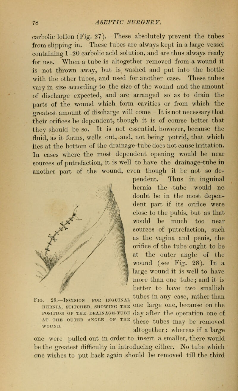 carbolic lotion (Fig. 27). These absolutely prevent the tubes from slipping in. These tubes are always kept in a large vessel containing 1-20 carbolic acid solution, and are thus always ready for use. When a tube is altogether removed from a wound it is not thrown away, but is washed and put into the bottle with the other tubes, and used for another case. These tubes vary in size according to the size of the wound and the amount of discharge expected, and are arranged so as to drain the parts of the wound which form cavities or from which the greatest amount of discharge will come It is not necessary that their orifices be dependent, though it is of course better that they should be so. It is not essential, however, because the fluid, as it forms, wells out, and, not being putrid, that w^hich lies at the bottom of the drainage-tube does not cause irritation. In cases where the most dependent opening would be near sources of putrefaction, it is well to have the drainage-tube in another part of the wound, even though it be not so de- pendent. Thus in inguinal hernia the tube would no doubt be in the most depen- dent part if its orifice were close to the pubis, but as that would be much too near sources of putrefaction, such as the vagina and penis, the orifice of the tube ought to be at the outer angle of the wound (see Fig. 28). In a large wound it is well to have more than one tube; and it is better to have two smallish tubes in any case, rather than HERNIA, STITCHED, SHOWING THE OHC large ouB, bccausc ou the POSITION OF THE DRAINAGE-TUBE day after the operation one of OUTER ANGLE OF THE ^|^ggg ^^j^^g ^^^ ^^ rCmOVCd altogether; whereas if a large one were pulled out in order to insert a smaller, there would be the gi-eatest difficulty in introducing either. No tube which one wishes to put back again should be removed till the third Fig. 28.—Incision for inguinal AT THE WOUND.