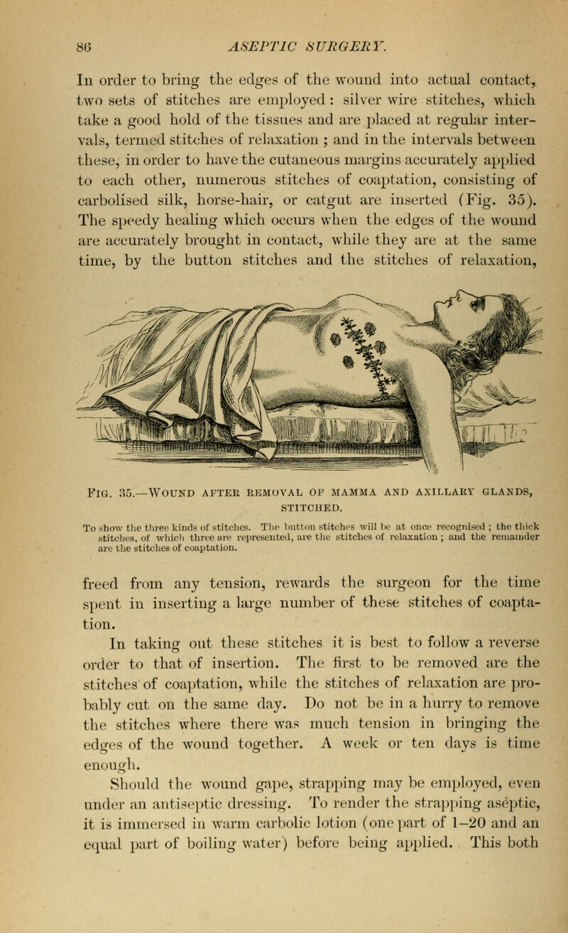 In order to bring the edges of the wound into actual contact, two sets of stitches are employed: silver wire stitches, which take a good hold of the tissues and are placed at regular inter- vals, termed stitches of relaxation ; and in the intervals between these, in order to have the cutaneous margins accurately applied to each other, numerous stitches of coaptation, consisting of carbolised silk, horse-hair, or catgut are inserted (Fig. 35). The speedy healing which occurs when the edges of the wound are accurately brought in contact, while they are at the same time, by the button stitches and the stitches of relaxation, Fig. 35.—Wound after removal oi'^ mamma and axillary glands, STITCHED. To show tlie tliree kinds of stitches. Tlip button .stitchrs will lie at onee recognised ; the tliick stitches, of which three arc represented, are the stitches of relaxation ; and the remainder are tlie stitches of coaptation. freed from any tension, rewards the surgeon for the time spent in inserting a large number of these stitches of coapta- tion. In taking out these stitches it is best to follow a reverse order to that of insertion. The first to be removed are the stitches of coaptation, while the stitches of relaxation are pro- bably cut on the same day. Do not be in a hurry to remove the stitches where there was much tension in bringing the edges of the wound together. A week or ten days is time enough. Should the wound gape, strapping may be employed, even under an antiseptic dressing. To render the stra])ping aseptic, it is immersed in warm carbolic lotion (one part of 1-20 and an equal part of boiling water) before being applied. This both