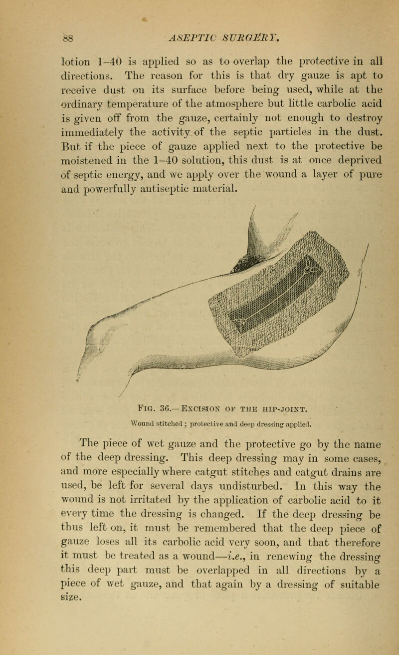 lotion 1—40 is applied so as to overlap the protective in all directions. The reason for this is that dry gauze is apt to receive dust on its surface before being used, while at the ordinary temperature of the atmosphere but little carbolic acid is given off from the gauze, certainly not enough to destroy immediately the activity of the septic particles in the dust. But if the piece of gauze applied next to the protective be moistened in the 1—iO solution, this dust is at once deprived of septic energy, and we apply over the wound a layer of pure and powerfully antiseptic material. Fig. 36.—Excision of the hip-joint. Wound stitclied ; ])rotective anil deep di-essing applied. The piece of wet gauze and the protective go by the name of the deep dressing. This deep dressing may in some cases, and more especially where catgut stitches and catgut drains are used, be left for several days undisturbed. In this way the wound is not irritated by the application of carbolic acid to it every time the dressing is changed. If the deep dressing be thus left on, it must be remembered that the deep piece of gauze loses all its carbolic acid very soon, and that therefore it must be treated as a wound—^.e., in renewing the dressing this deep part must be overlapped in all directions by a piece of wet gauze, and that again by a dressing of suitable size.