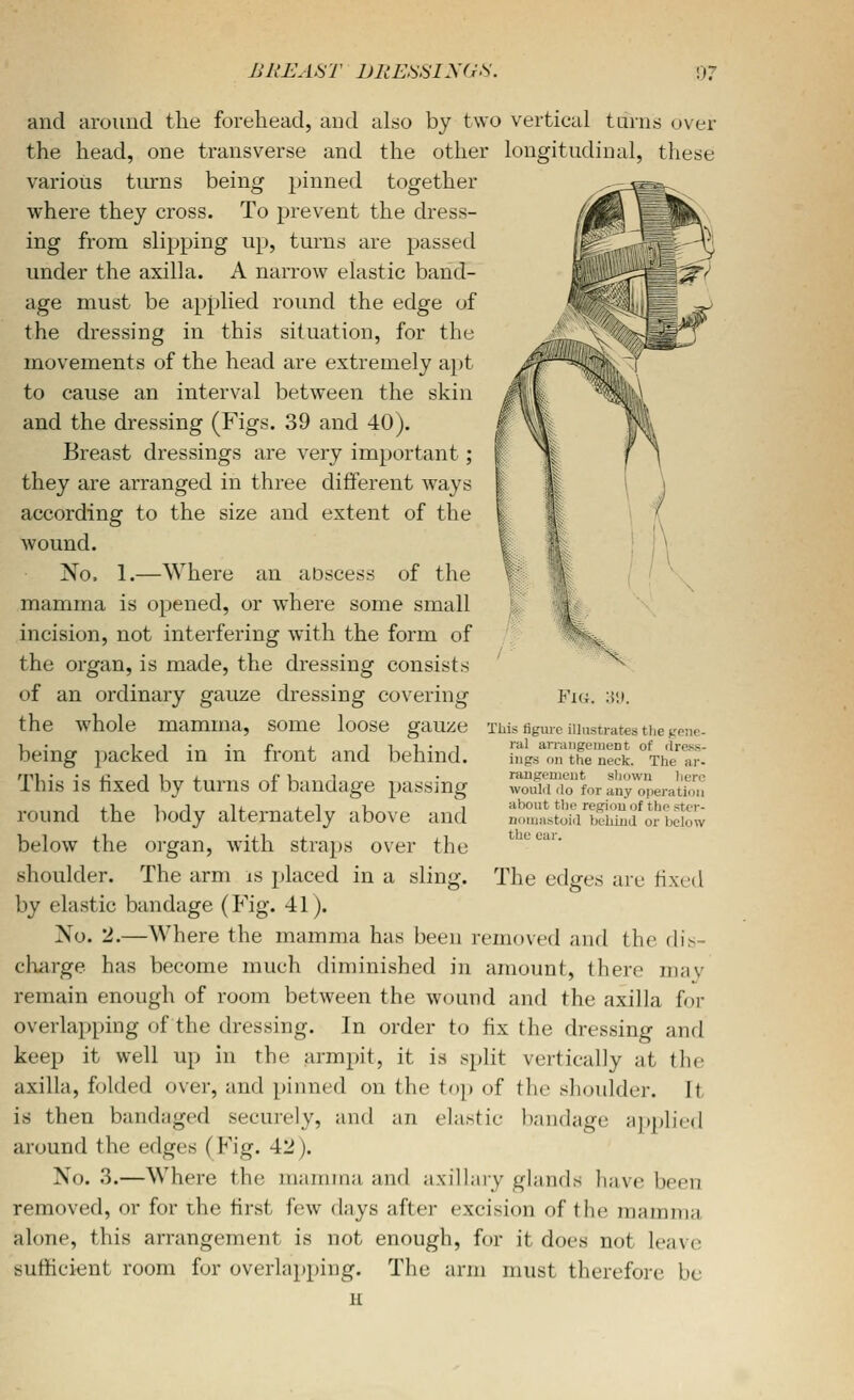 and around the forehead, and also by two vertical turns over the head, one transverse and the other longitudinal, these various tiurns being pinned together where they cross. To prevent the dress- ing from slipping up, turns are passed under the axilla. A narrow elastic band- age must be applied round the edge of the dressing in this situation, for the movements of the head are extremely a})t to cause an interval between the skin and the dressing (Figs. 39 and 40). Breast dressings are very important; they are arranged in three different ways according to the size and extent of the wound. No. 1.—Where an abscess of the mamma is opened, or where some small incision, not interfering with the form of the organ, is made, the dressing consists of an ordinary gauze dressing covering Fig. 3j. the whole mamma, some loose gauze This figme illustrates the genr. being packed in in front and behind. '' ^'''■^'^■^^ °f '»■•«- This is fixed by turns of bandage passing round the body alternately above and below the organ, with straps over the shoulder. The arm is placed in a sling. by elastic bandage (Fig. 41). No. 2.—Where the mamma has been removed and the dis- charge has become much diminished in amount, there mav remain enough of room between the wound and the axilla for overlapping of the dressing. In order to fix the dressing and keep it well up in the armpit, it is split vertically at the axilla, folded over, and pinned on the top of tlie shoulder. It is then bandaged securely, and an elastic bandage a])i)lir(l around the edges (Fig. 42). No. 3.—Where the mamma and axillary glands have been removed, or for the first few days after excision of the mamma alone, this arrangement is not enough, for it does not leave sufficient room for overlajipiiig. The arm must therefore be nigs on the neck. The ar- rangement shown liero would do for any operation about the region of the stcv- nouia.stoid behind or below the ear. The edges are fixed